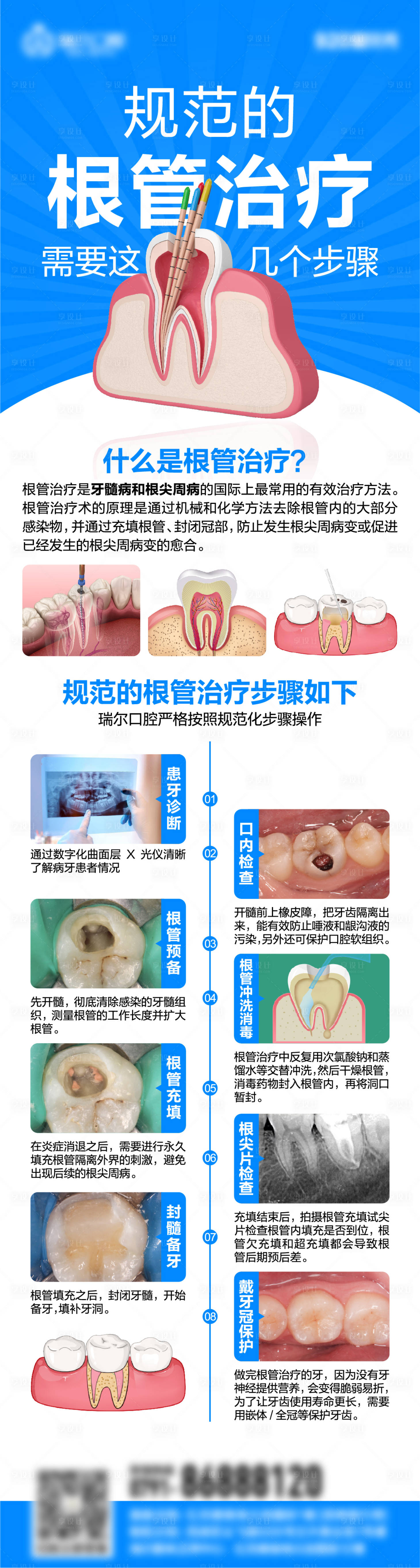 源文件下载【享设计】搜索编号：26020026663024478【根管治疗流程】
