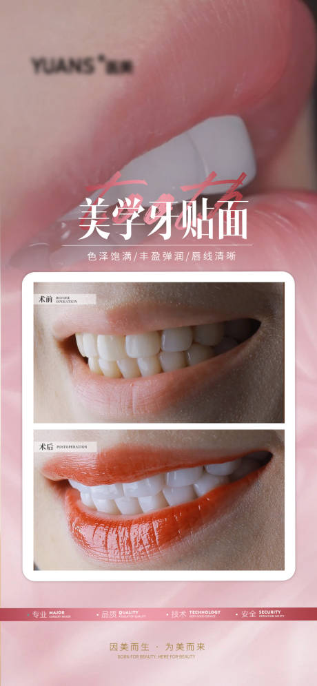 医美牙齿贴面案例海报