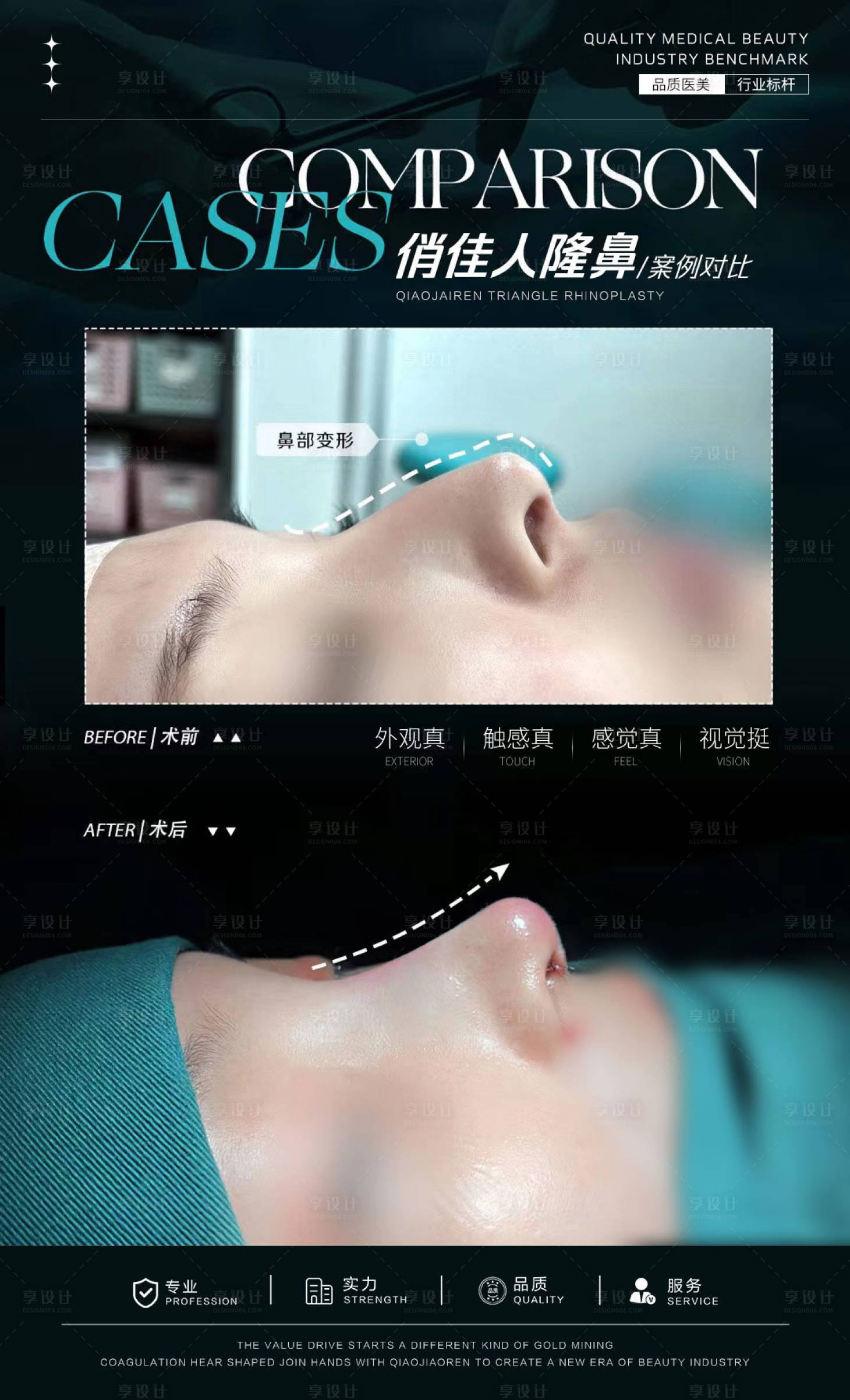 源文件下载【隆鼻案例海报】编号：99120026963914235