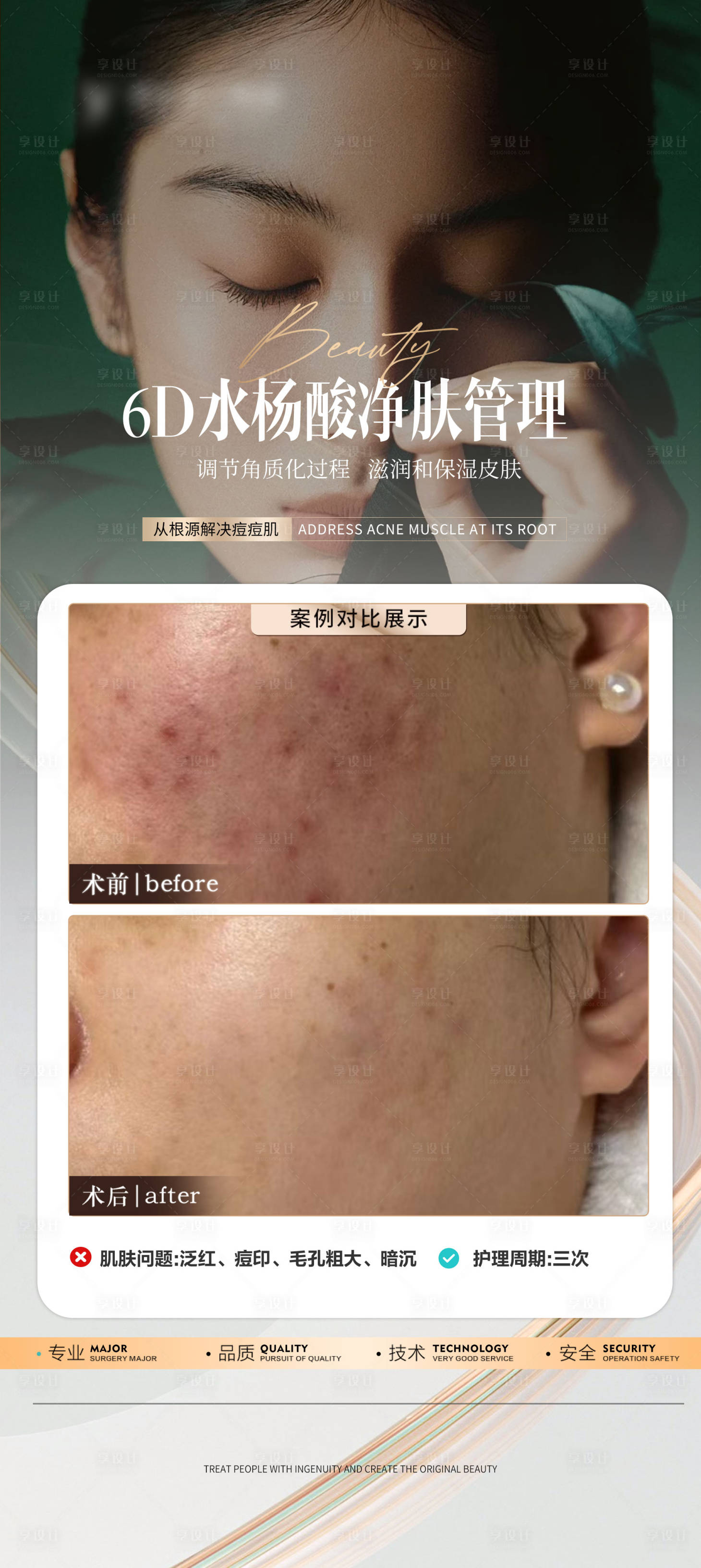 源文件下载【享设计】搜索编号：77950026628037874【医美刷酸水杨酸案例海报】