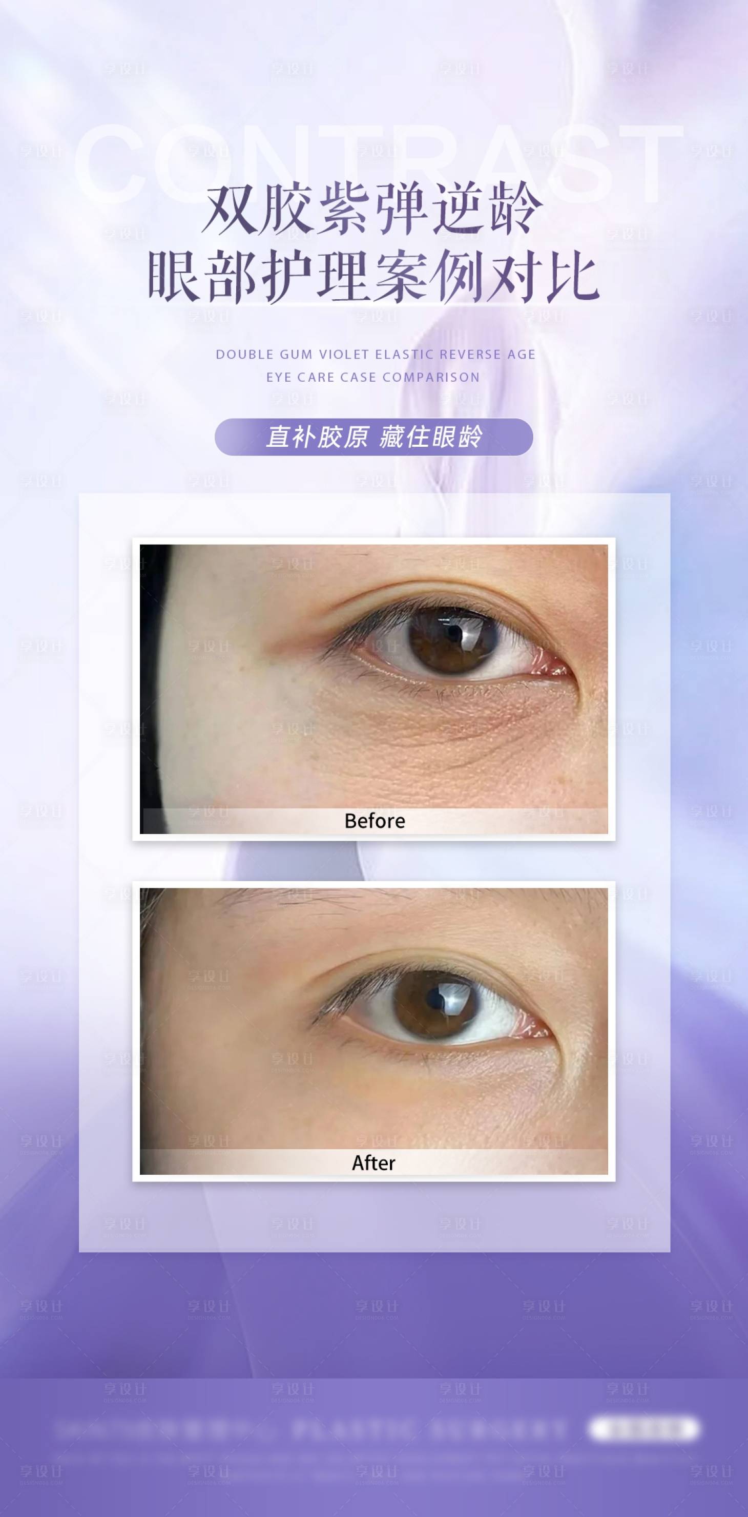源文件下载【享设计】搜索编号：27530027274006889【眼部案例对比海报】