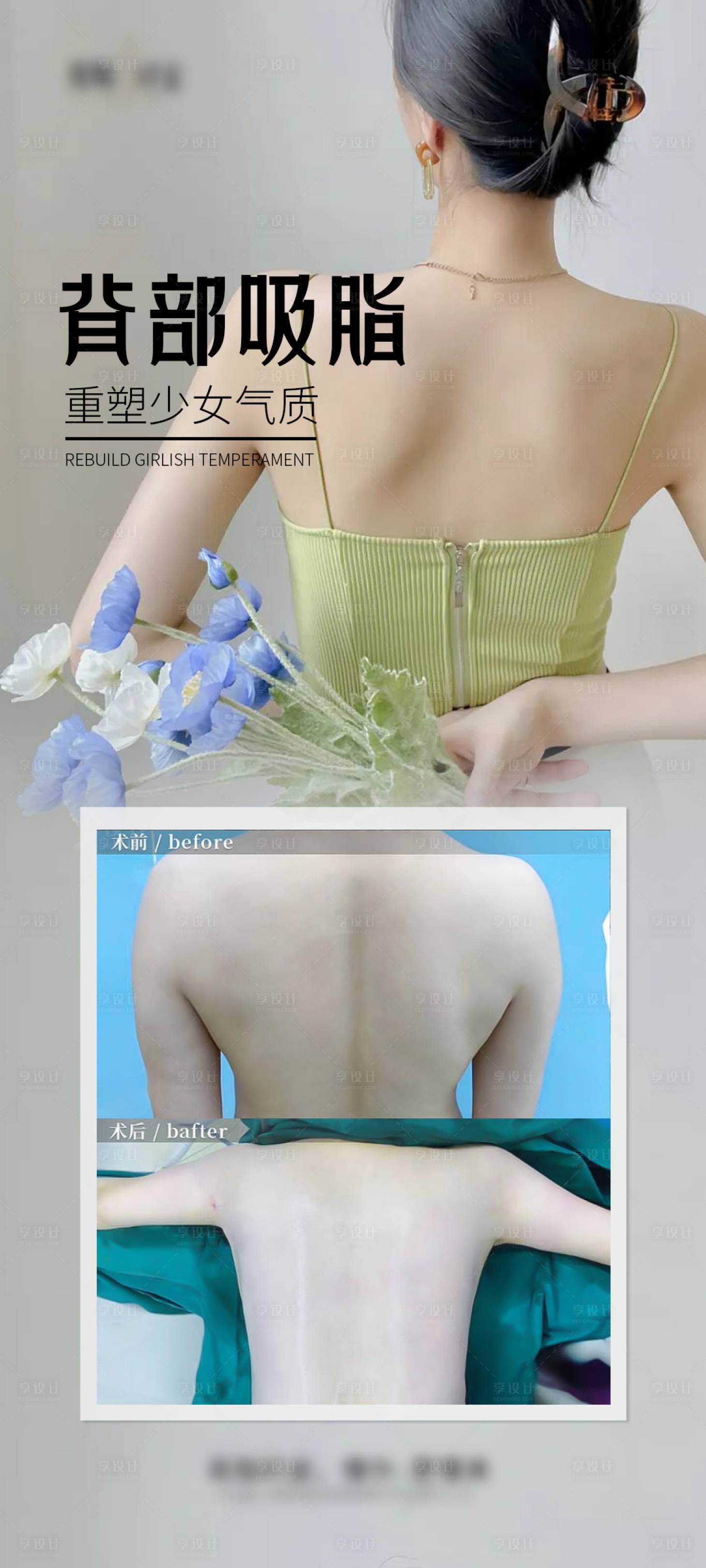 源文件下载【享设计】搜索编号：32650027519565065【少女背吸脂案例宣传海报】