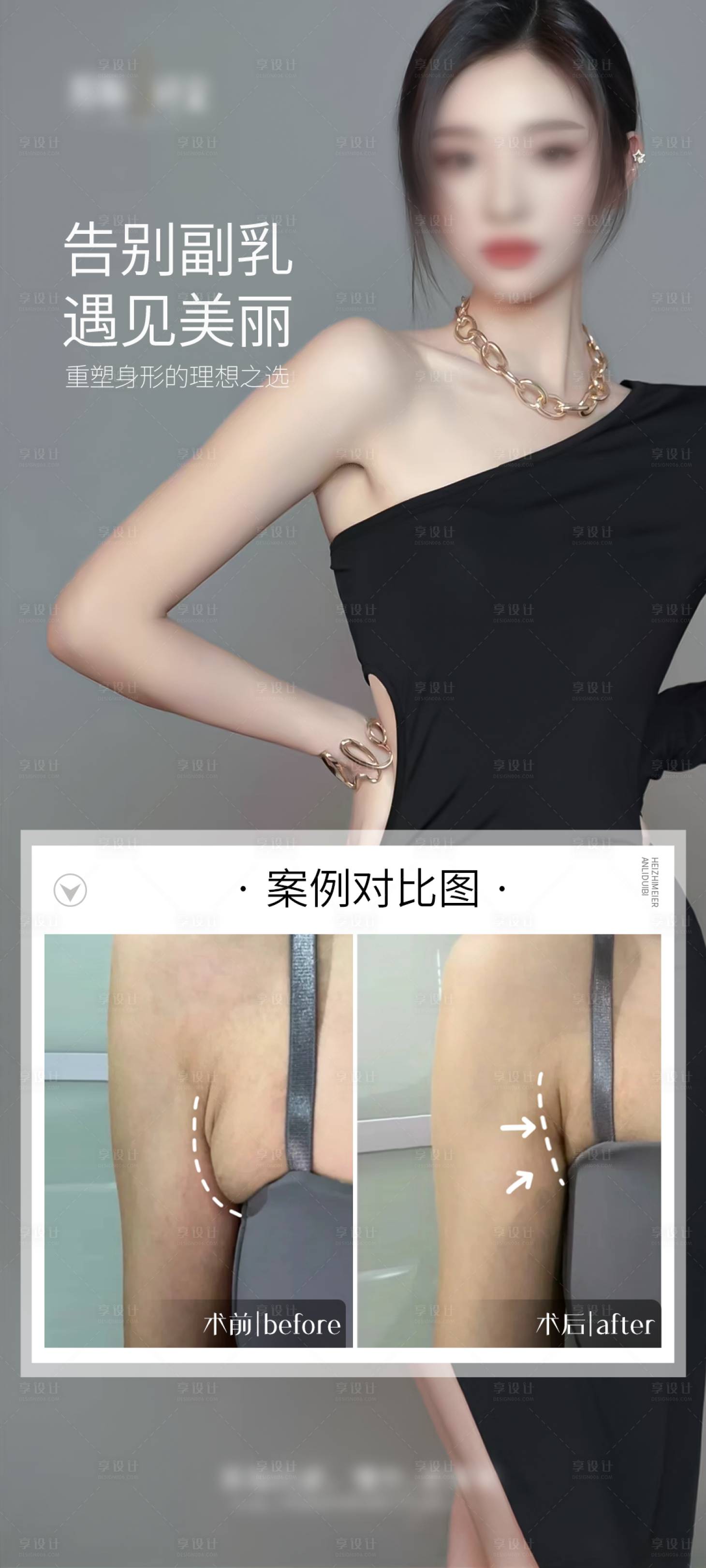 源文件下载【副乳吸脂案例海报】编号：52650027432016879