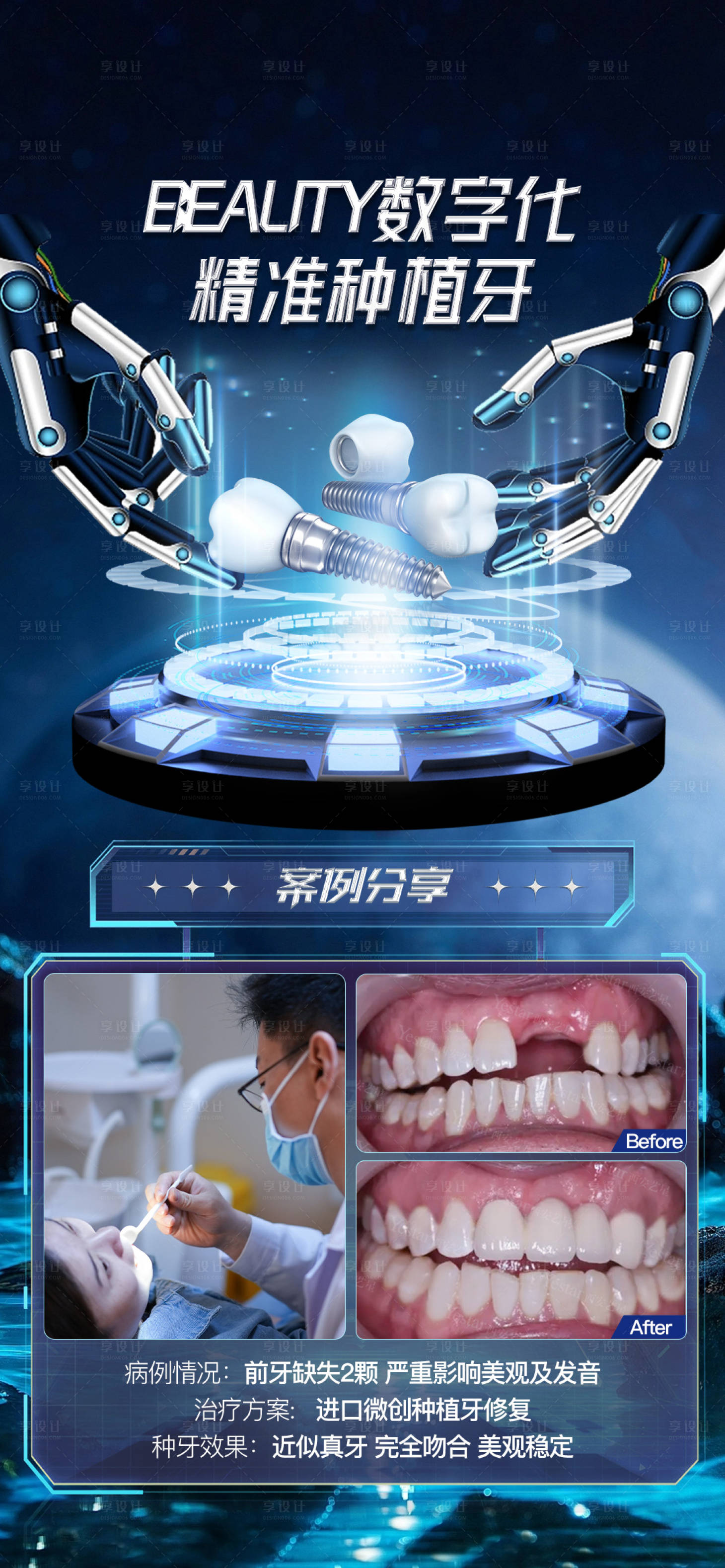 源文件下載【口腔種植牙海報】編號：58760027306197614