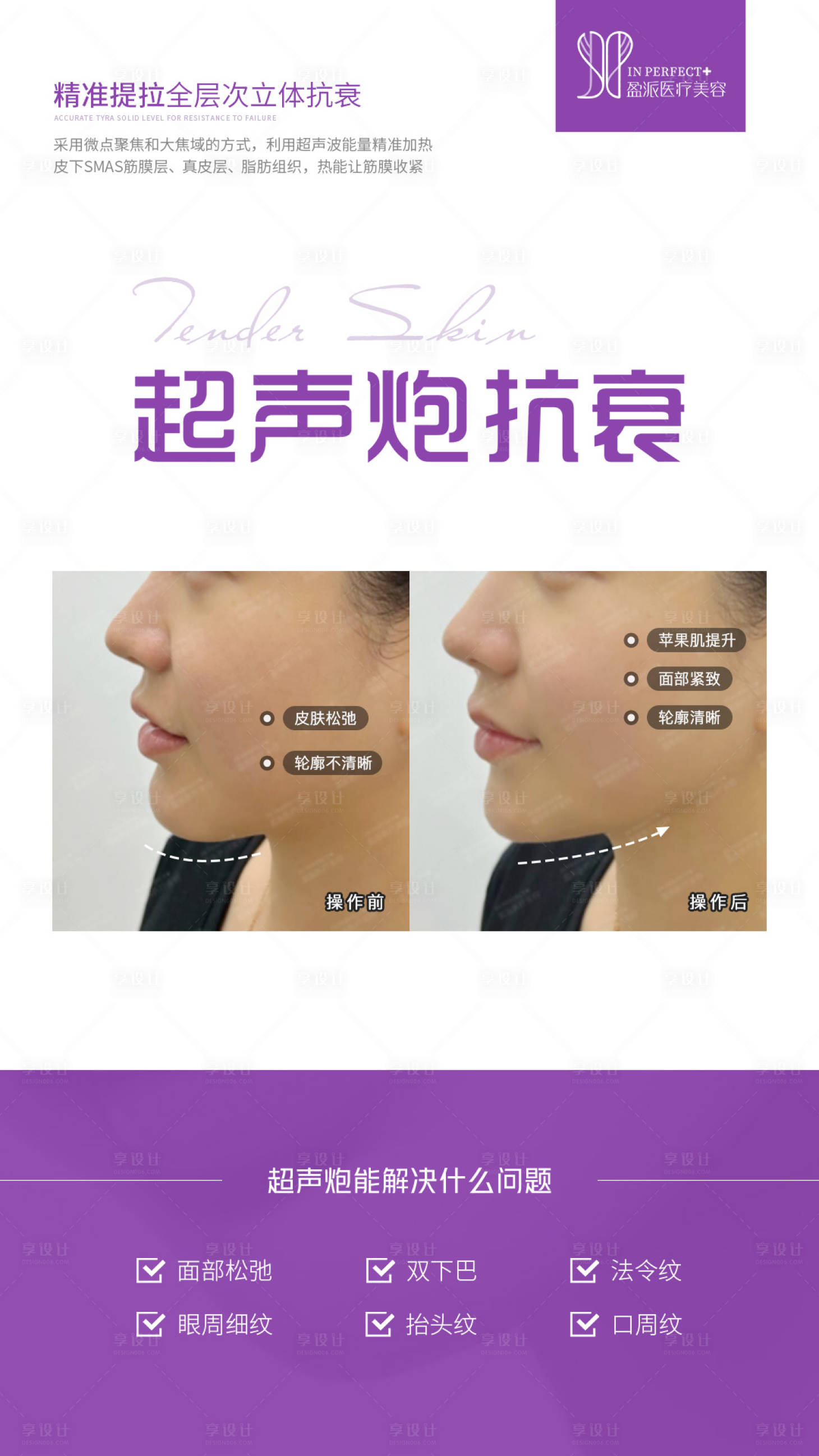 源文件下載【享設(shè)計】搜索編號：14620027240948554【超聲炮對比案例海報】