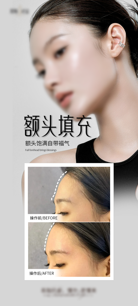 源文件下載【享設(shè)計(jì)】搜索編號(hào)：11760027145516838【醫(yī)美額頭填充海報(bào)】