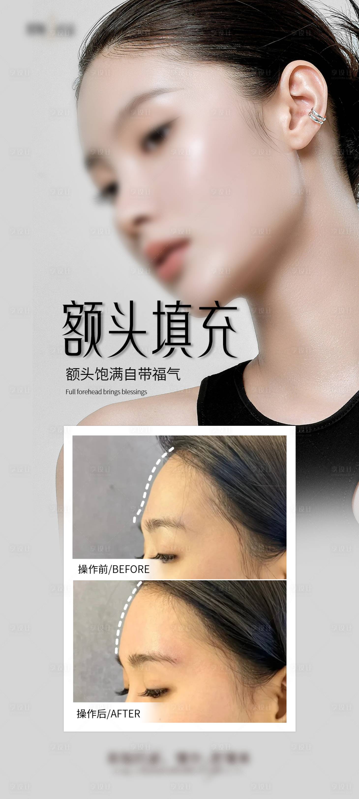 源文件下載【享設(shè)計】搜索編號：11760027145516838【醫(yī)美額頭填充海報】