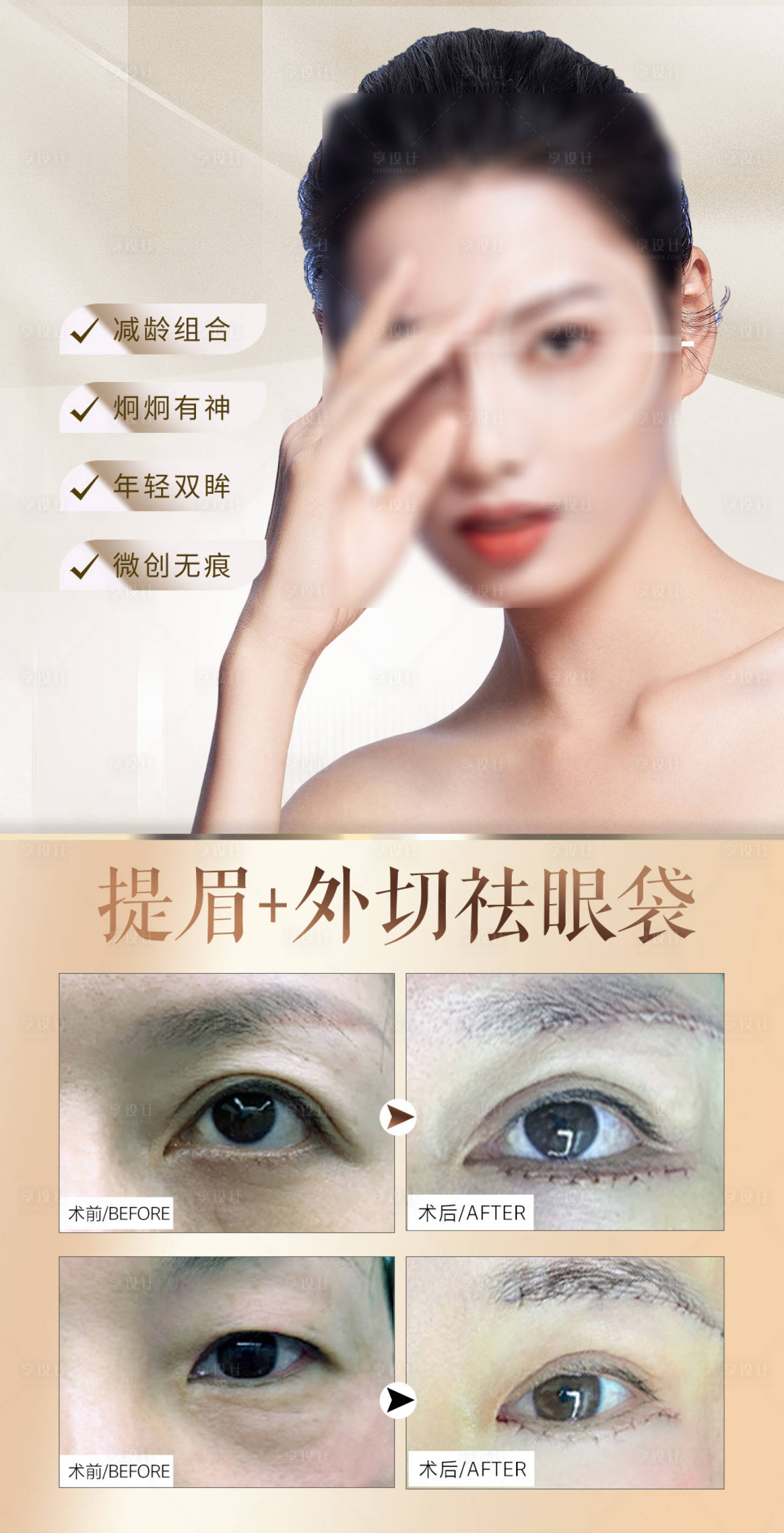 源文件下載【享設計】搜索編號：98680027234933557【提眉祛眼袋案例】