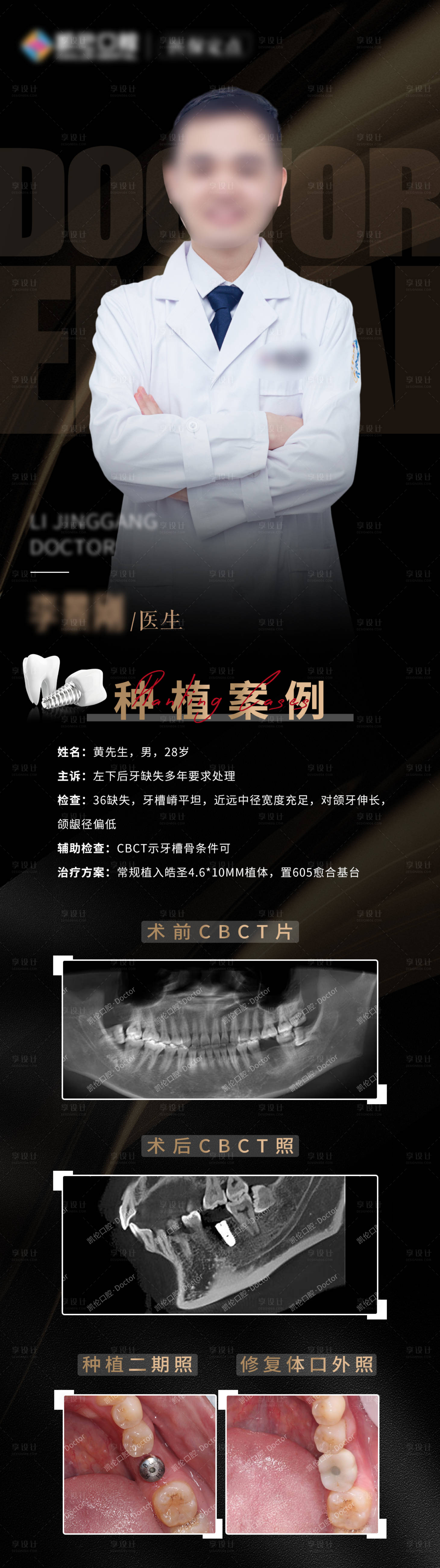 源文件下载【享设计】搜索编号：27080027298308003【种植病例海报】