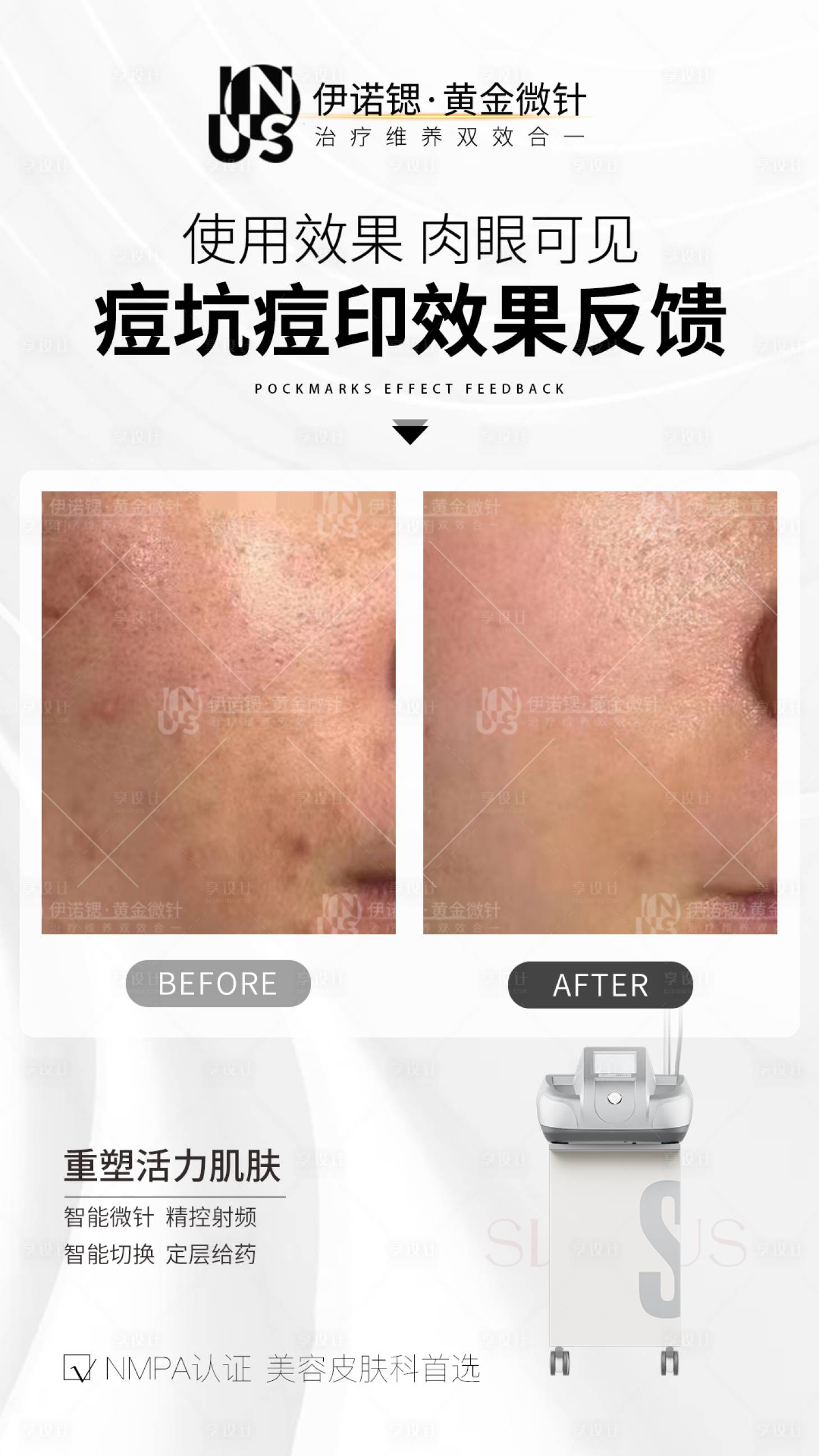 源文件下載【享設計】搜索編號：66060027631779379【醫美伊諾鍶黃金微針產品海報】