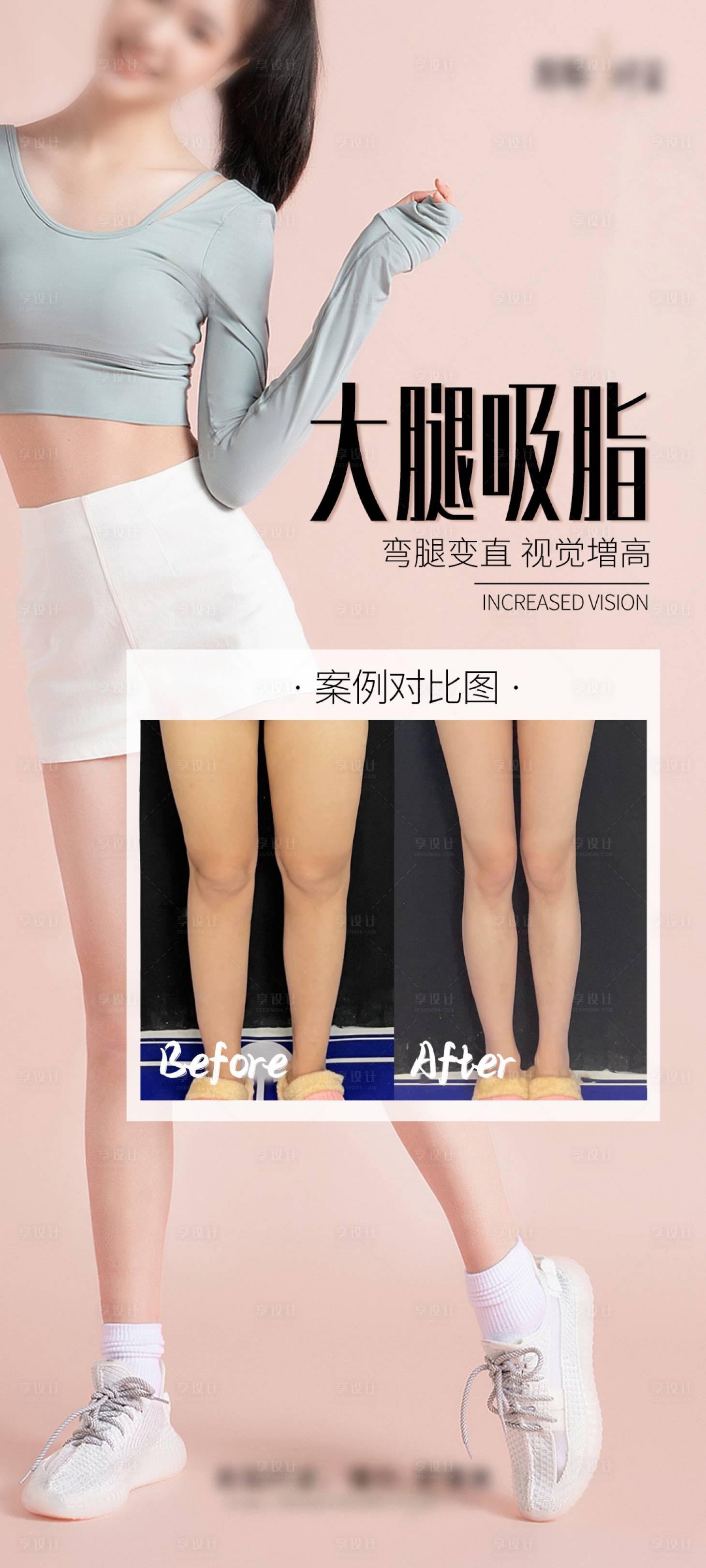 源文件下載【享設計】搜索編號：17190027617839408【大腿吸脂海報】