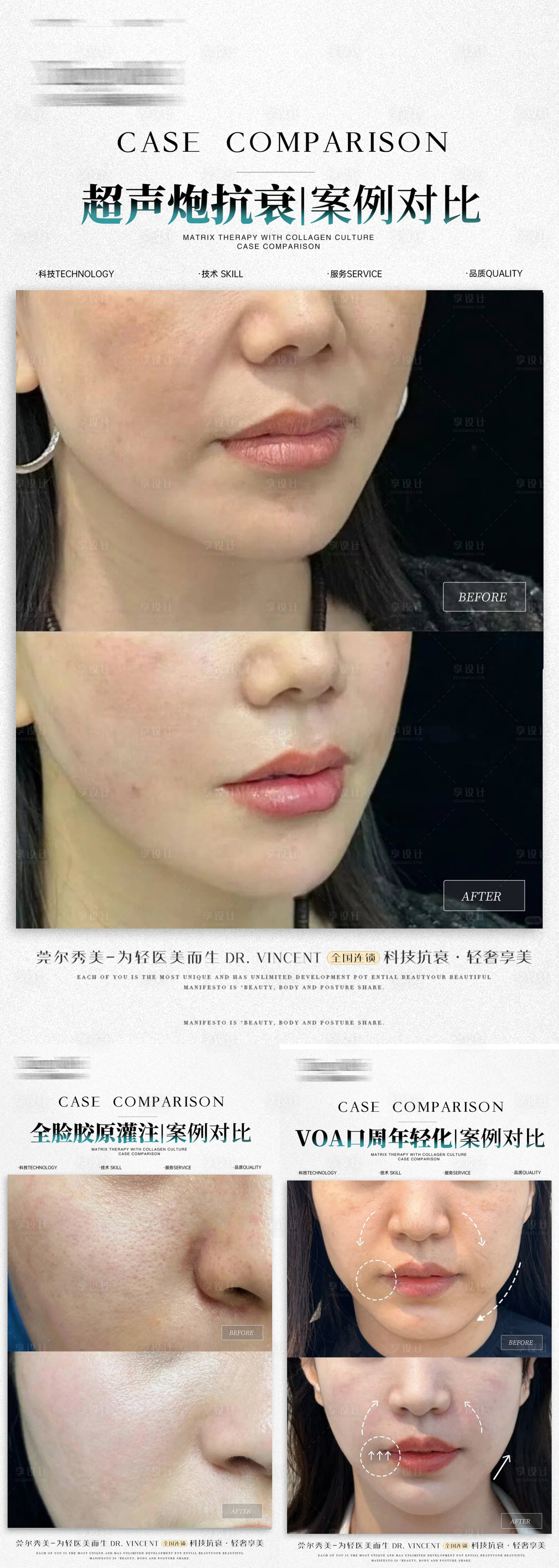 源文件下載【享設計】搜索編號：94410028158423796【醫美超聲炮膠原口周案例分享系列海報】