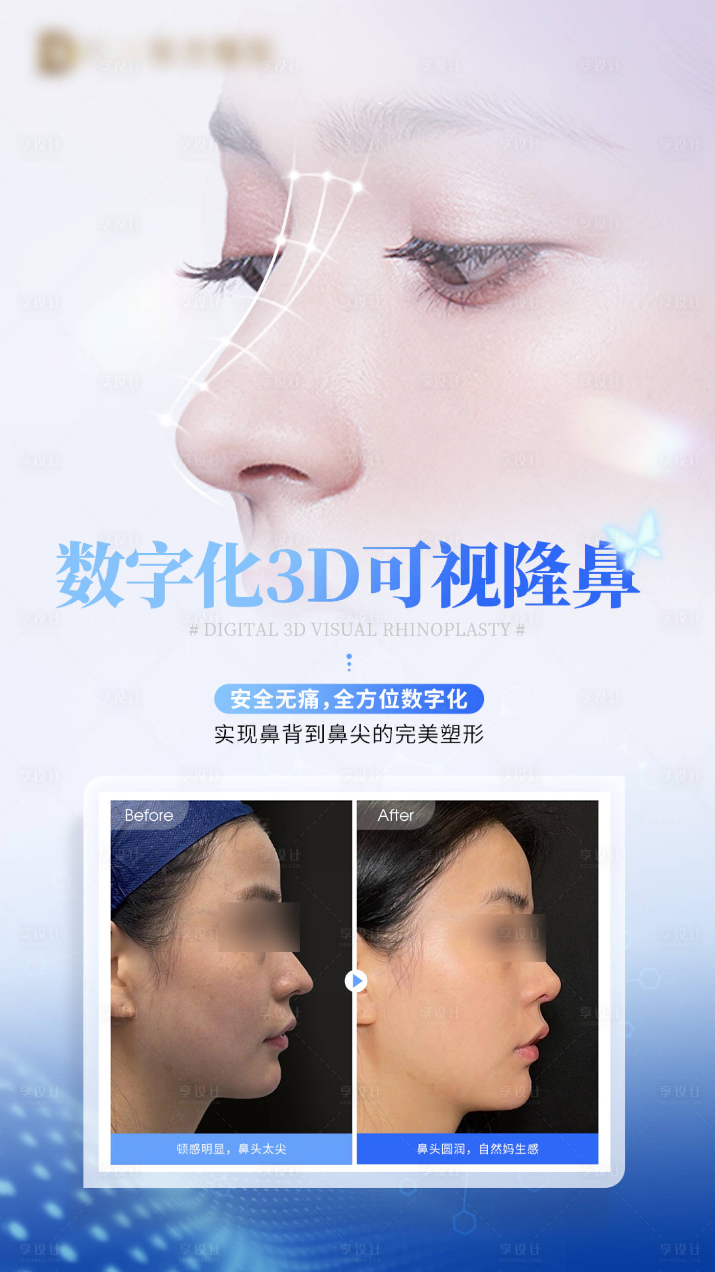源文件下载【享设计】搜索编号：26740027842009444【数字化隆鼻海报】
