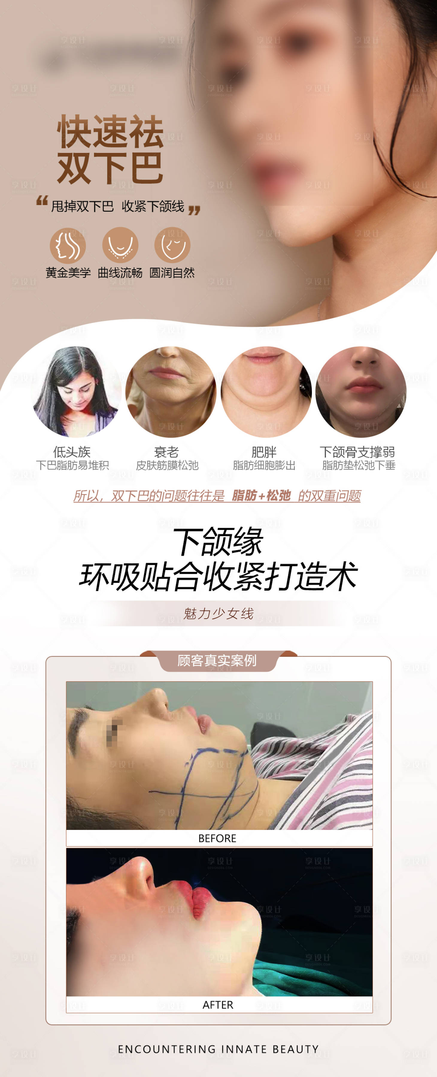 源文件下載【享設計】搜索編號：95860027666511862【醫美雙下巴吸脂案例對比】