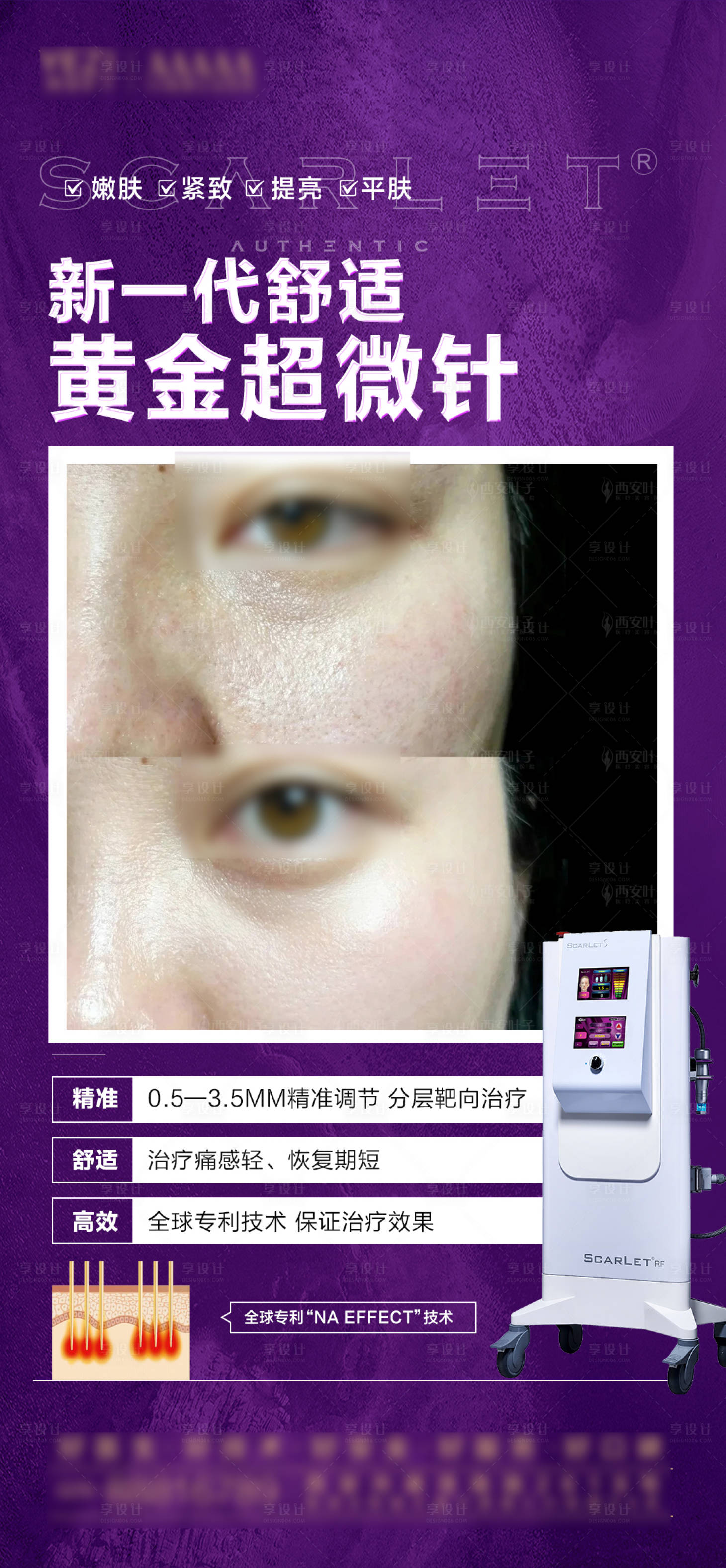 源文件下載【享設計】搜索編號：81050028158728644【黃金微針案例海報】