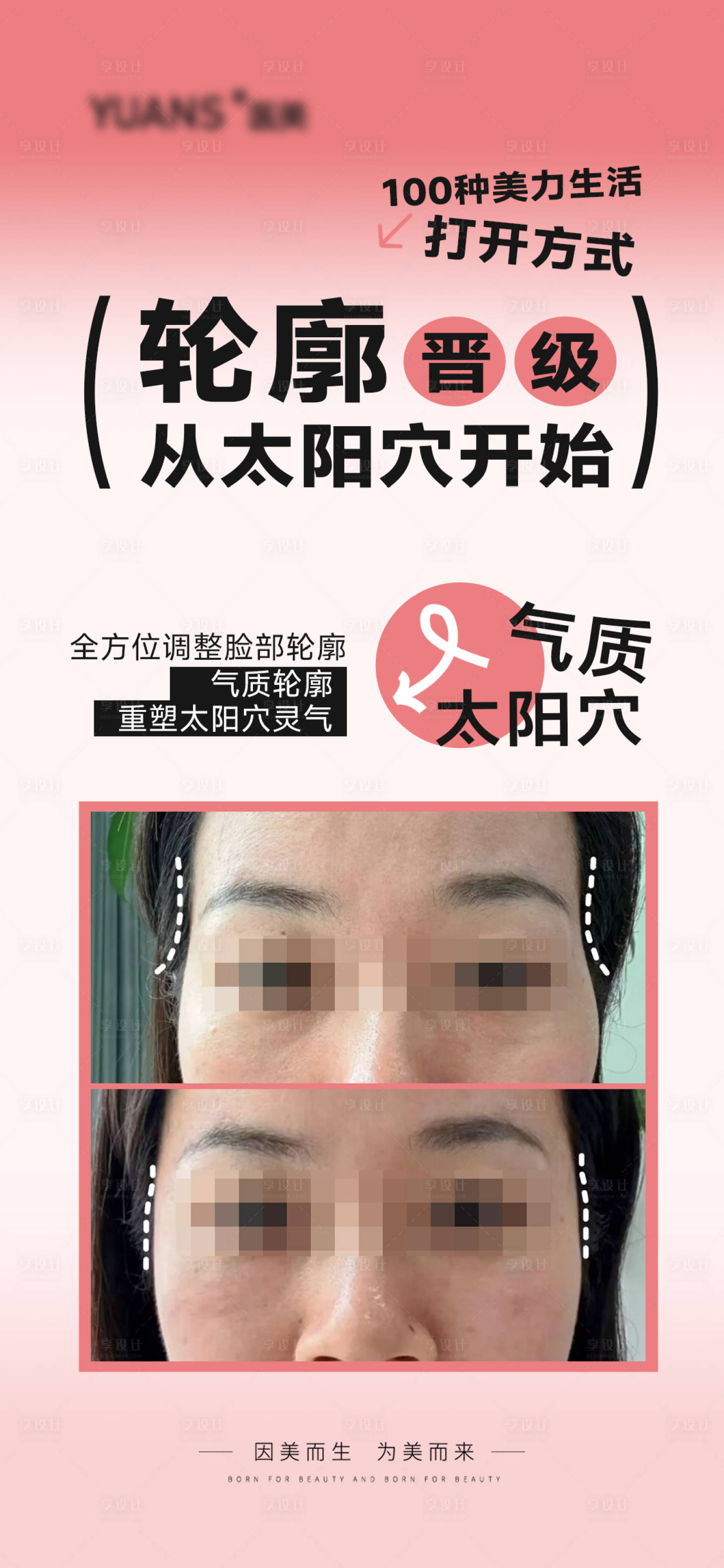 源文件下载【享设计】搜索编号：83640027749897768【医美太阳穴填充案例对比海报】