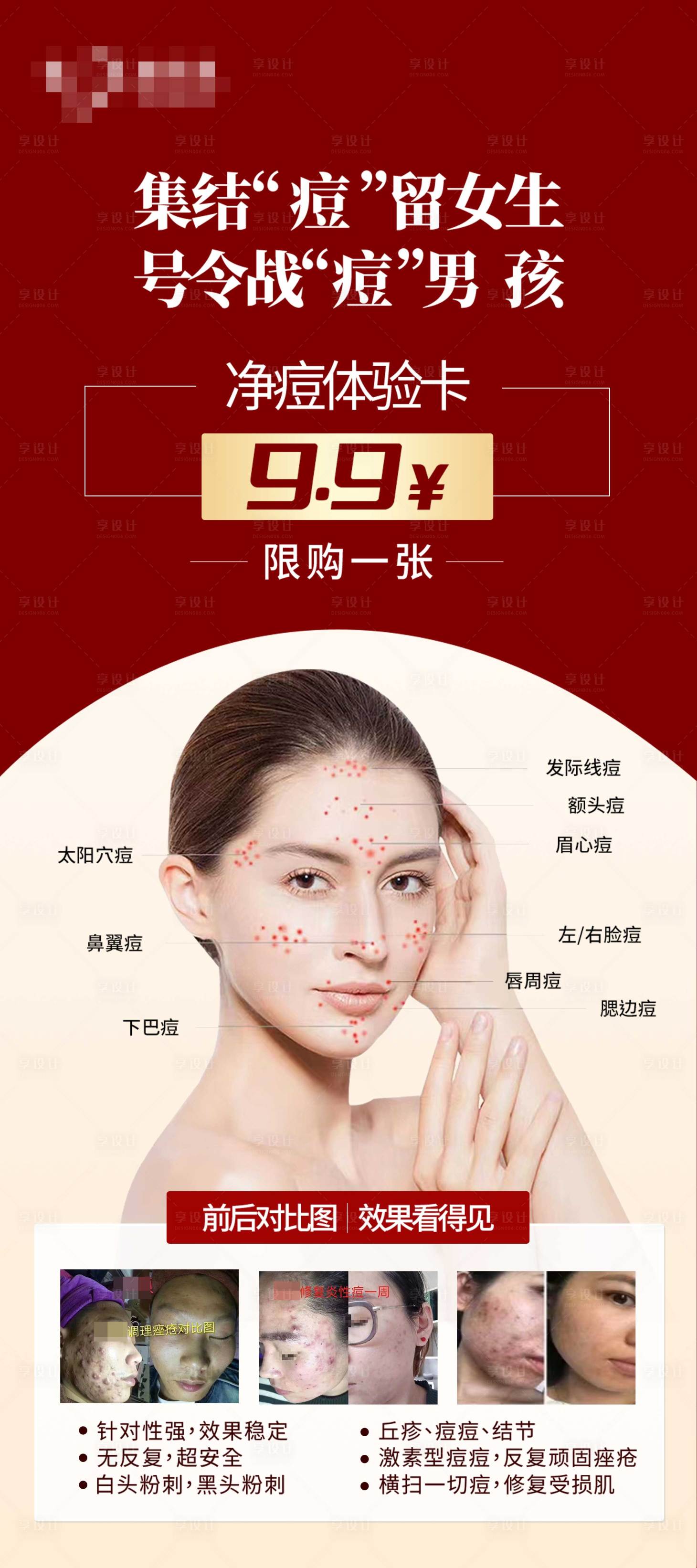 源文件下載【享設(shè)計(jì)】搜索編號(hào)：38490028587826071【祛痘紅色展架醫(yī)美祛痘海報(bào)】