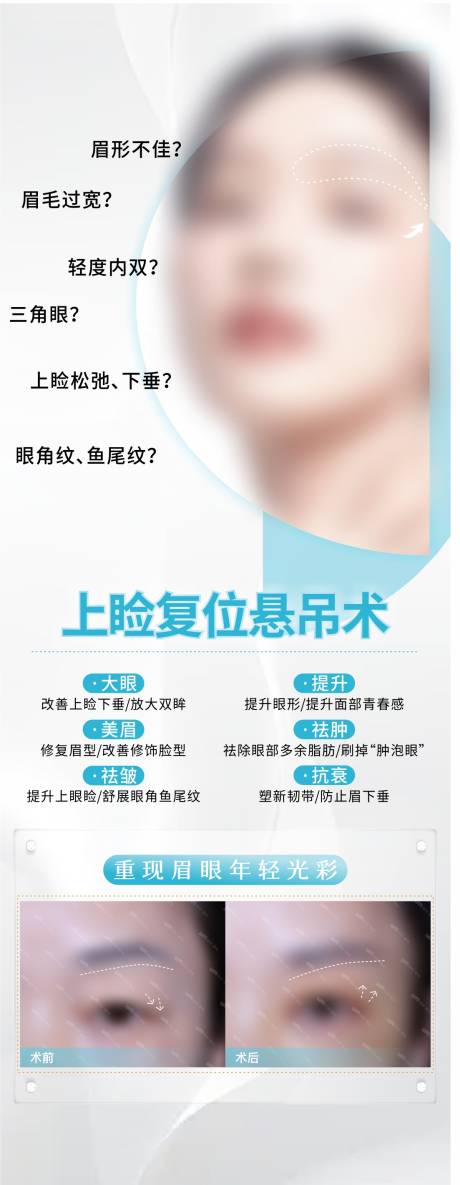 上睑复位悬吊术