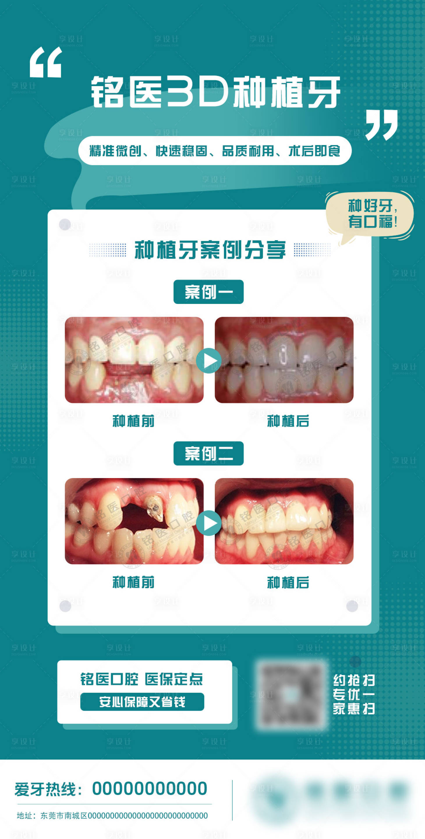 源文件下載【享設計】搜索編號：51610028381883768【種植牙案例分享海報】