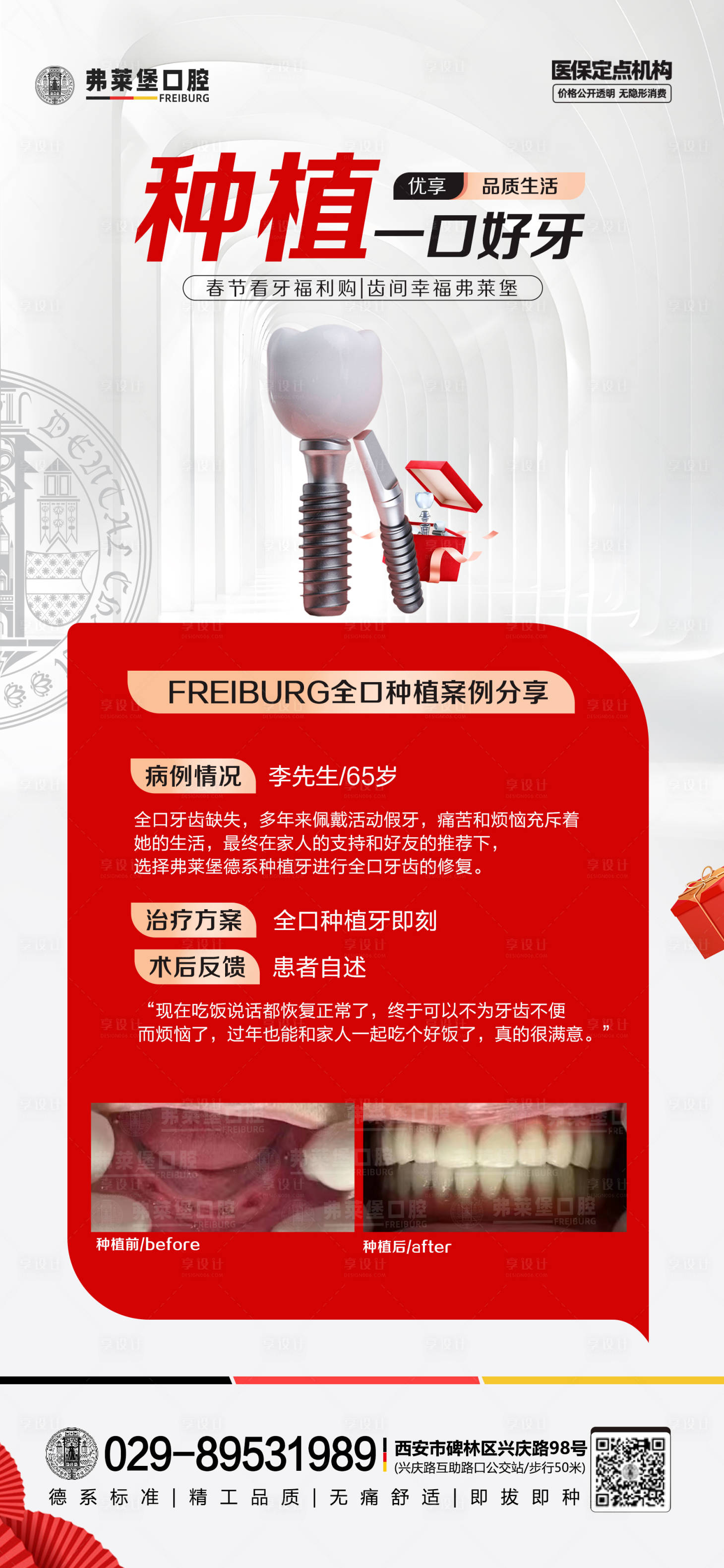源文件下載【享設計】搜索編號：96440028429147625【種植牙案例海報】