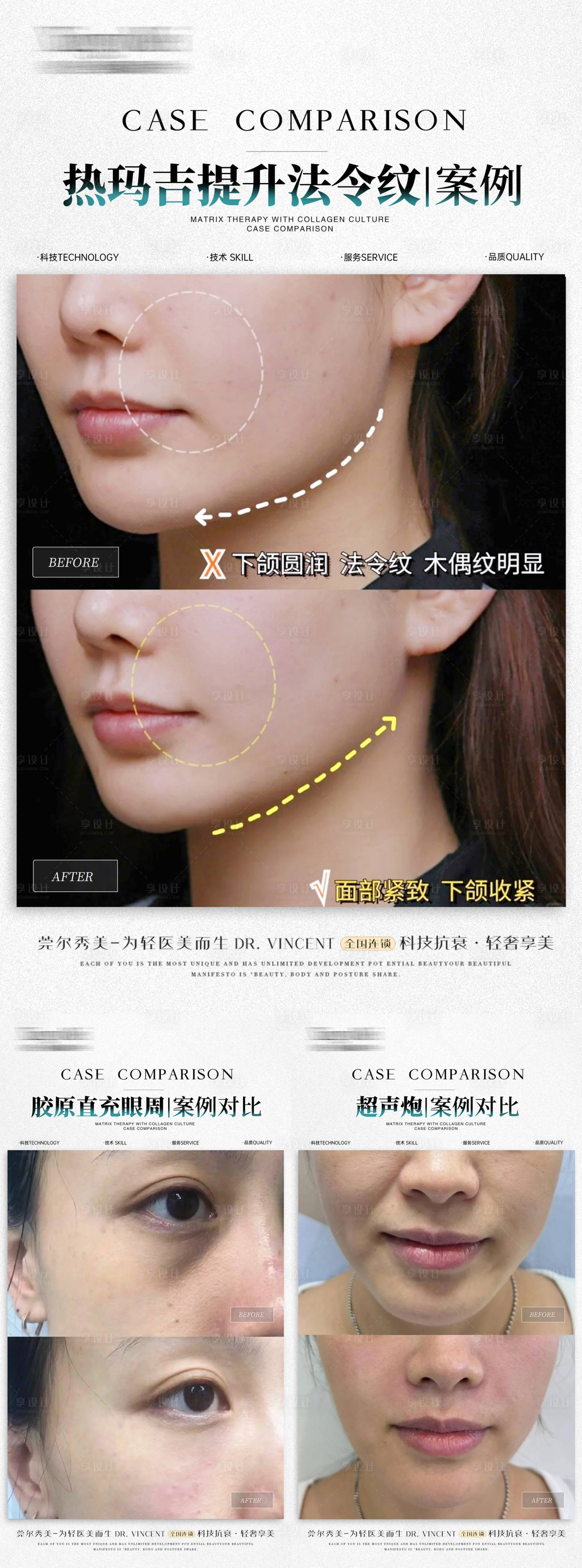 源文件下載【享設計】搜索編號：28690028495348382【醫美熱瑪吉膠原超聲炮案例】