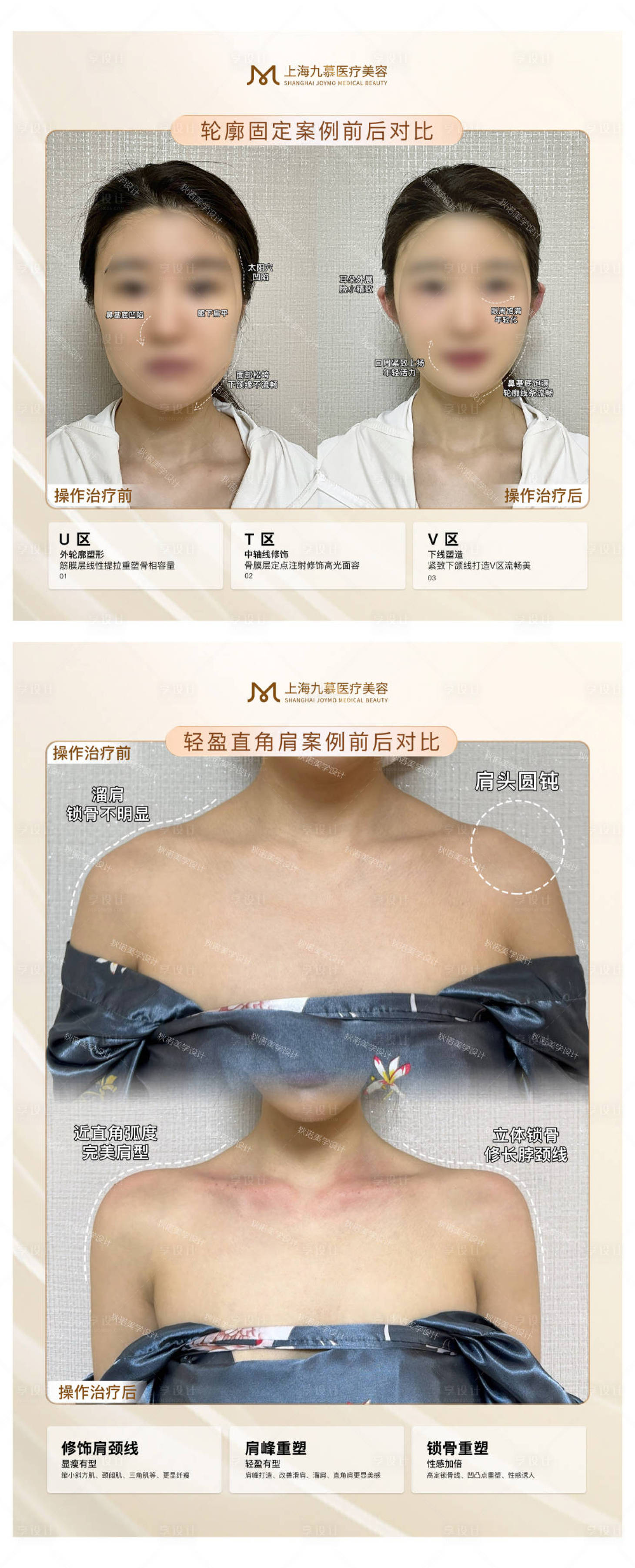 源文件下載【享設計】搜索編號：55790028392716794【醫美案例對比解析海報】