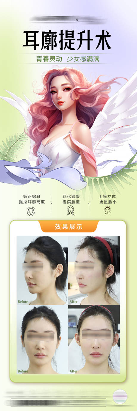 源文件下載【耳廓提升術海報】編號：56520029076587273