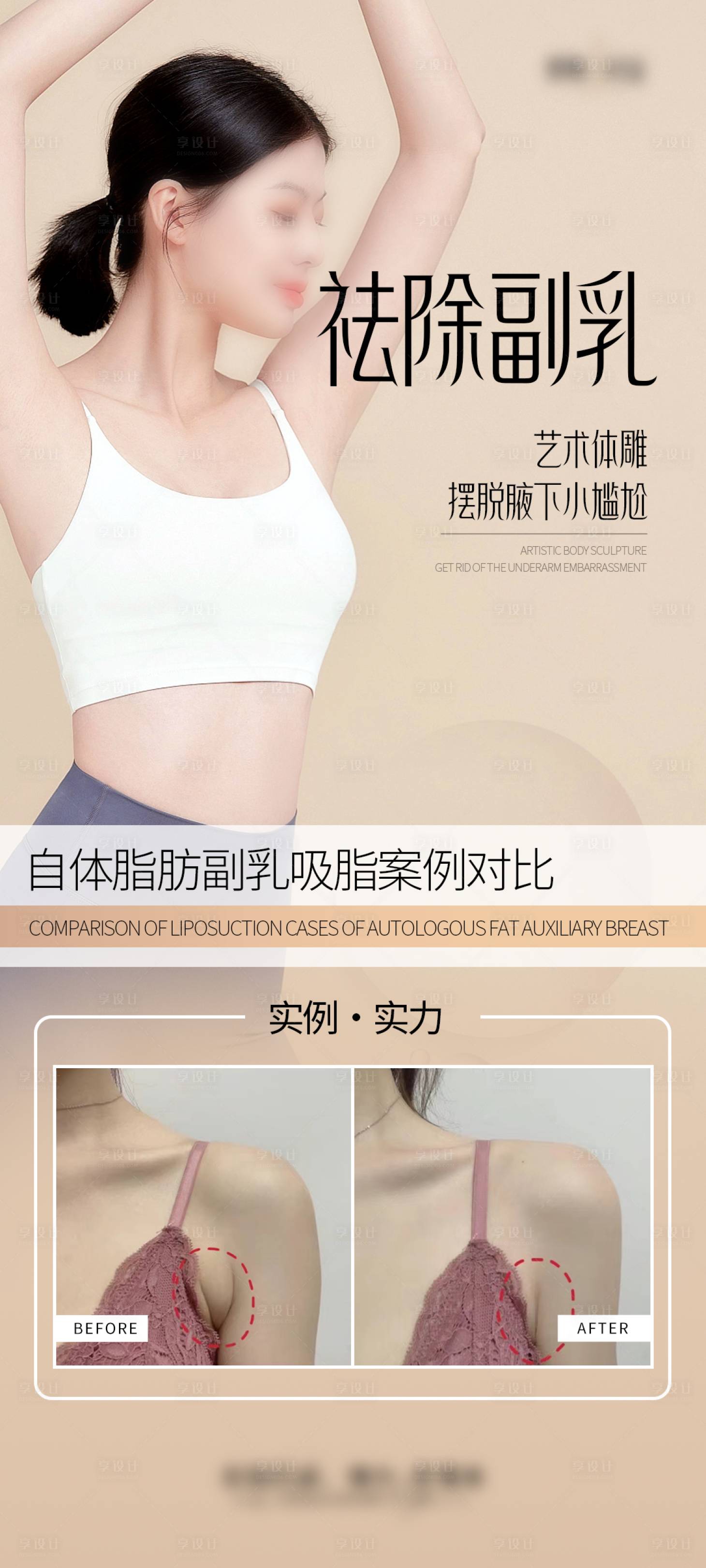 源文件下载【祛除副乳案例宣传海报】编号：42900028758888696