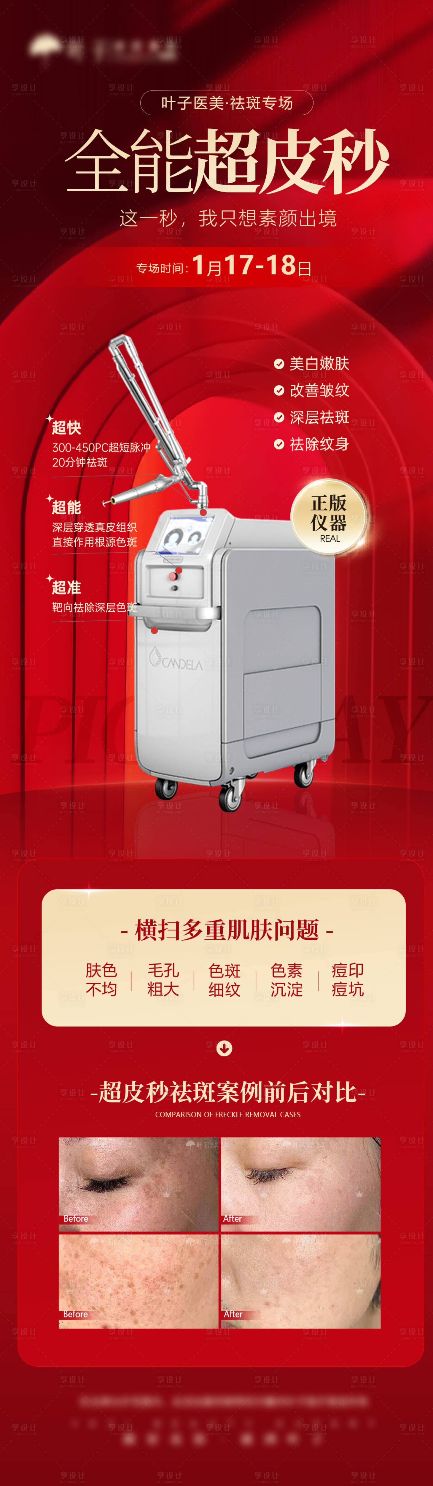 源文件下載【享設(shè)計(jì)】搜索編號：97340028938428418【超皮秒祛斑】