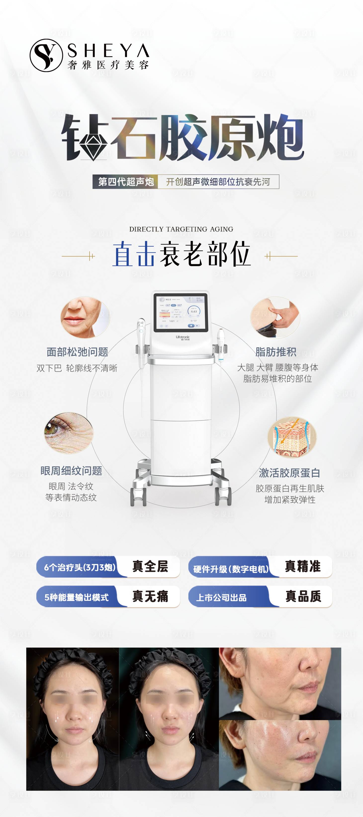 源文件下载【享设计】搜索编号：71550028875065551【医美仪器超声V拉美超声刀】