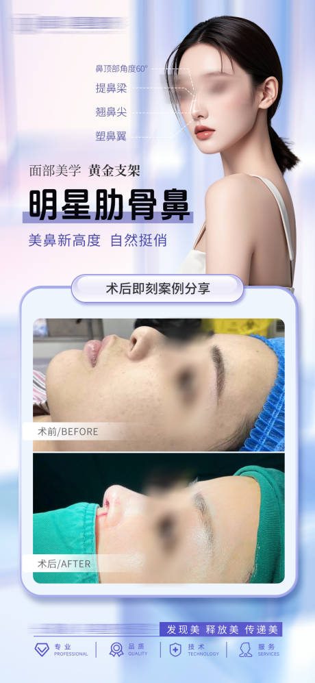 肋骨鼻鼻综合案例海报