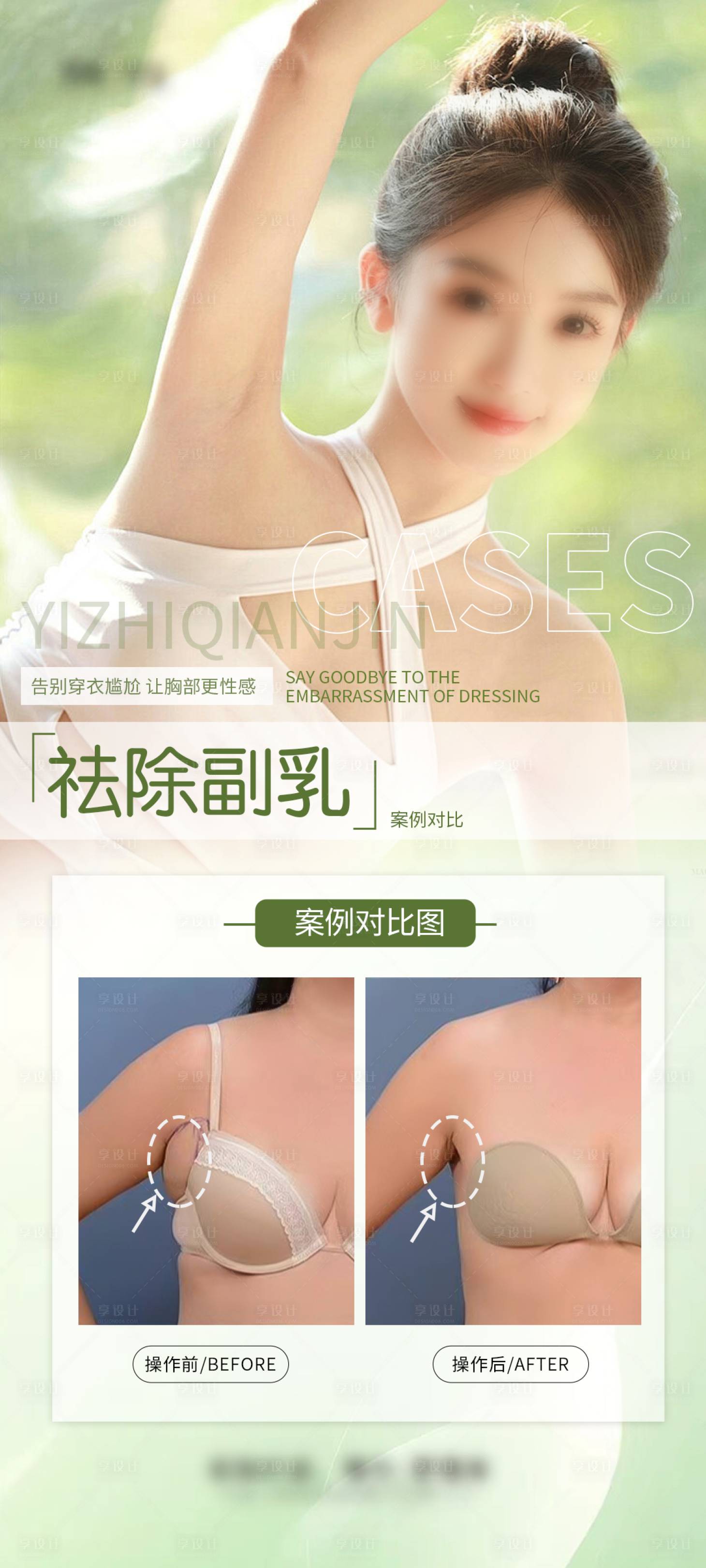 源文件下载【祛除副乳案例海报】编号：60820028971246305