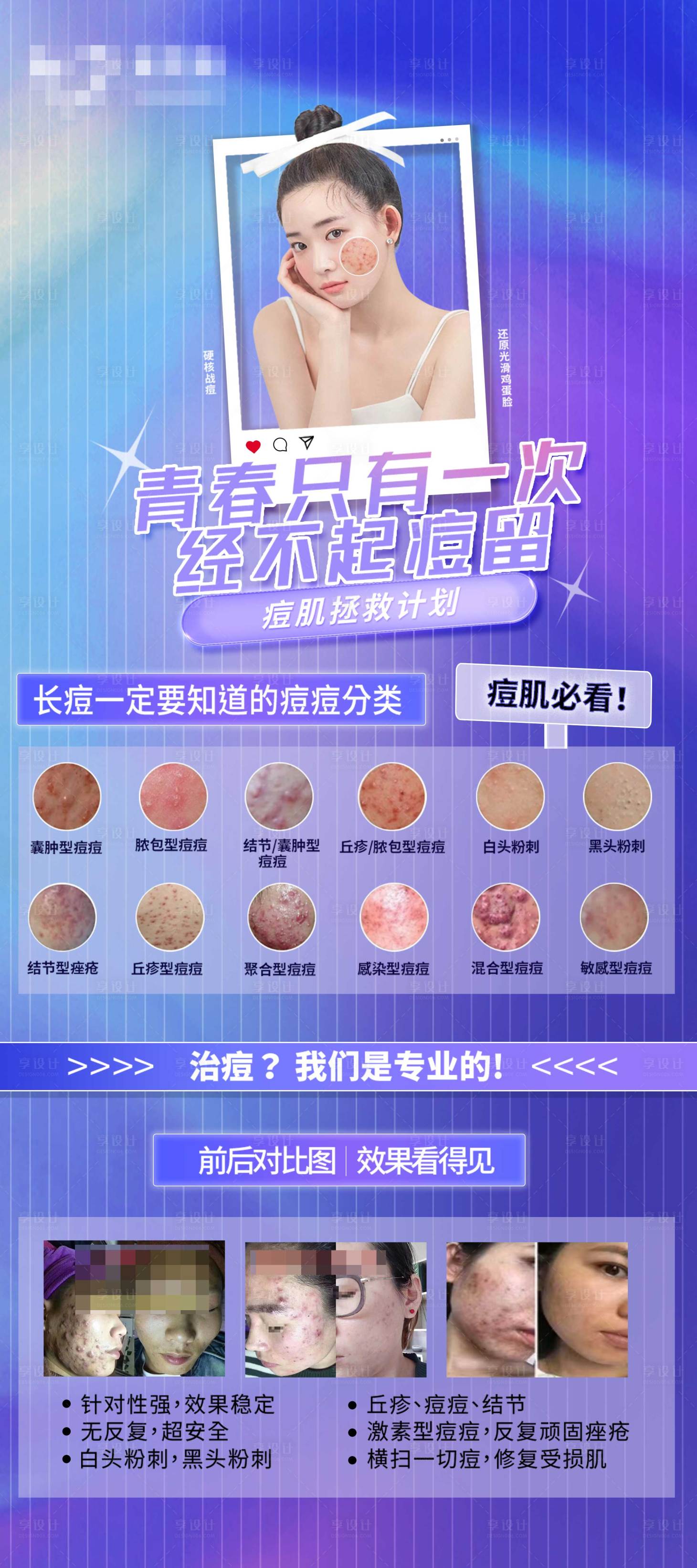 源文件下載【享設計】搜索編號：46370028820042483【祛痘展架 】