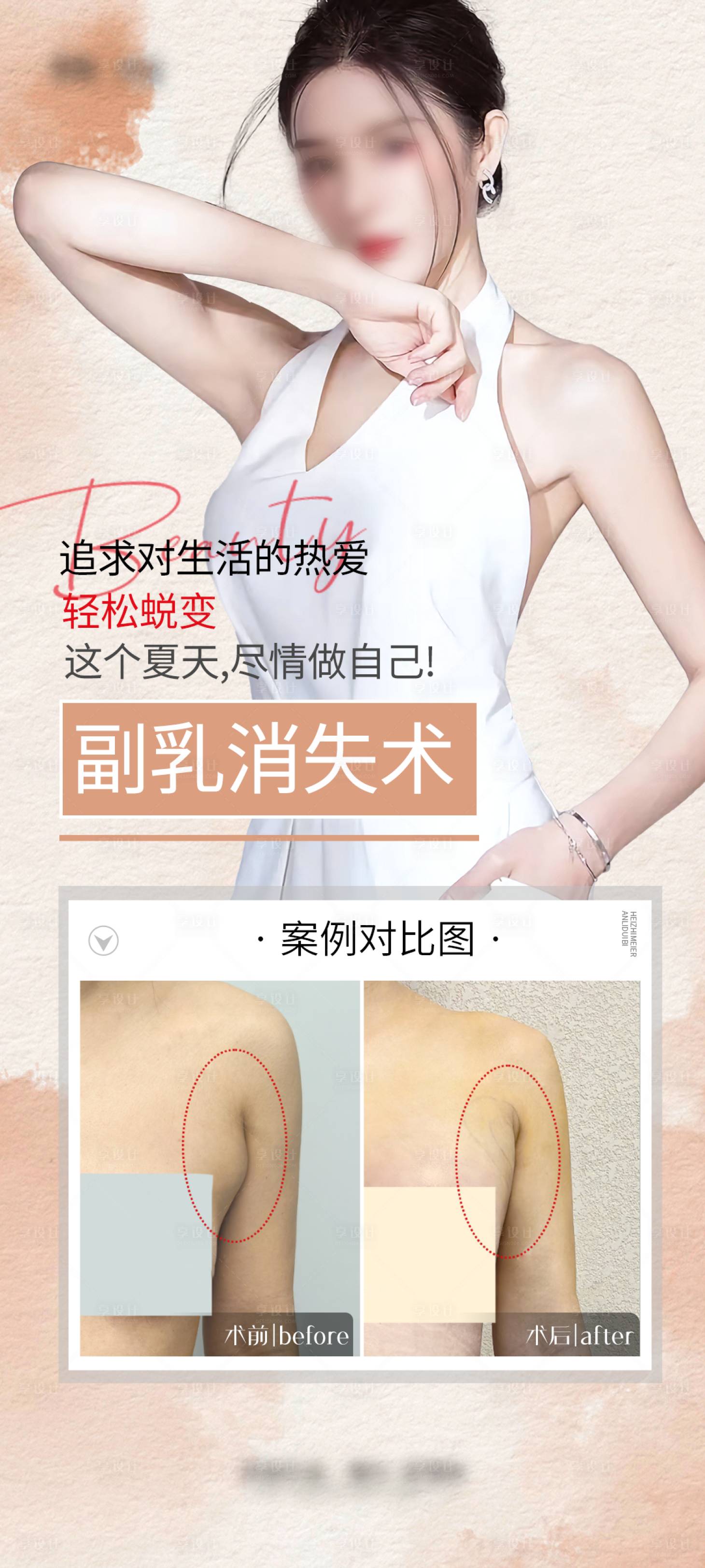 源文件下载【祛除副乳案例海报】编号：13640029049791134