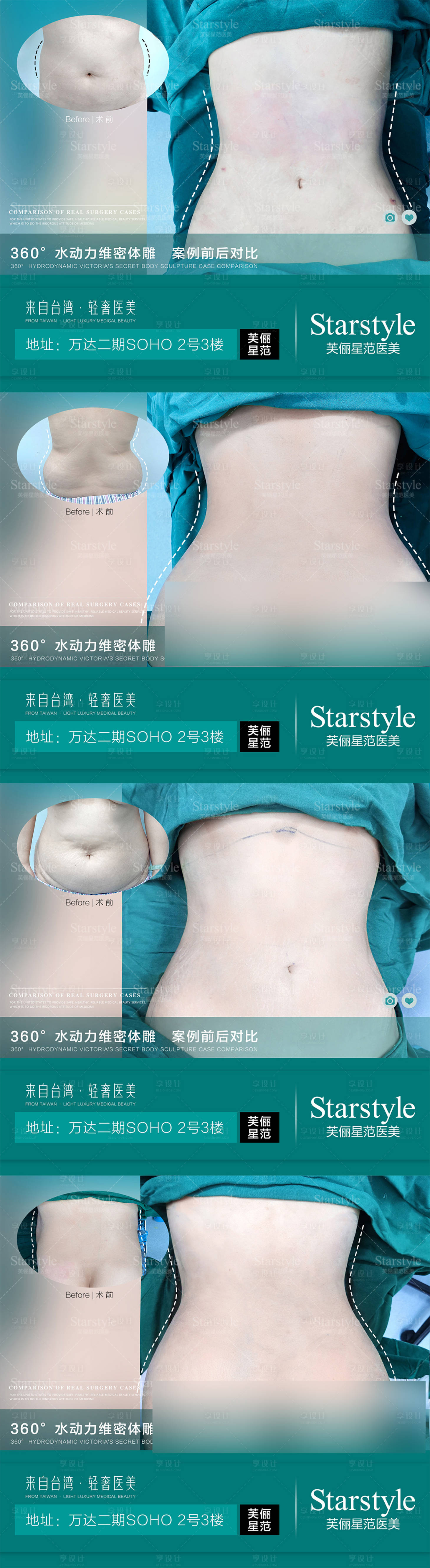 源文件下載【享設計】搜索編號：15080020687298117【醫(yī)美吸脂案例對比系列海報】