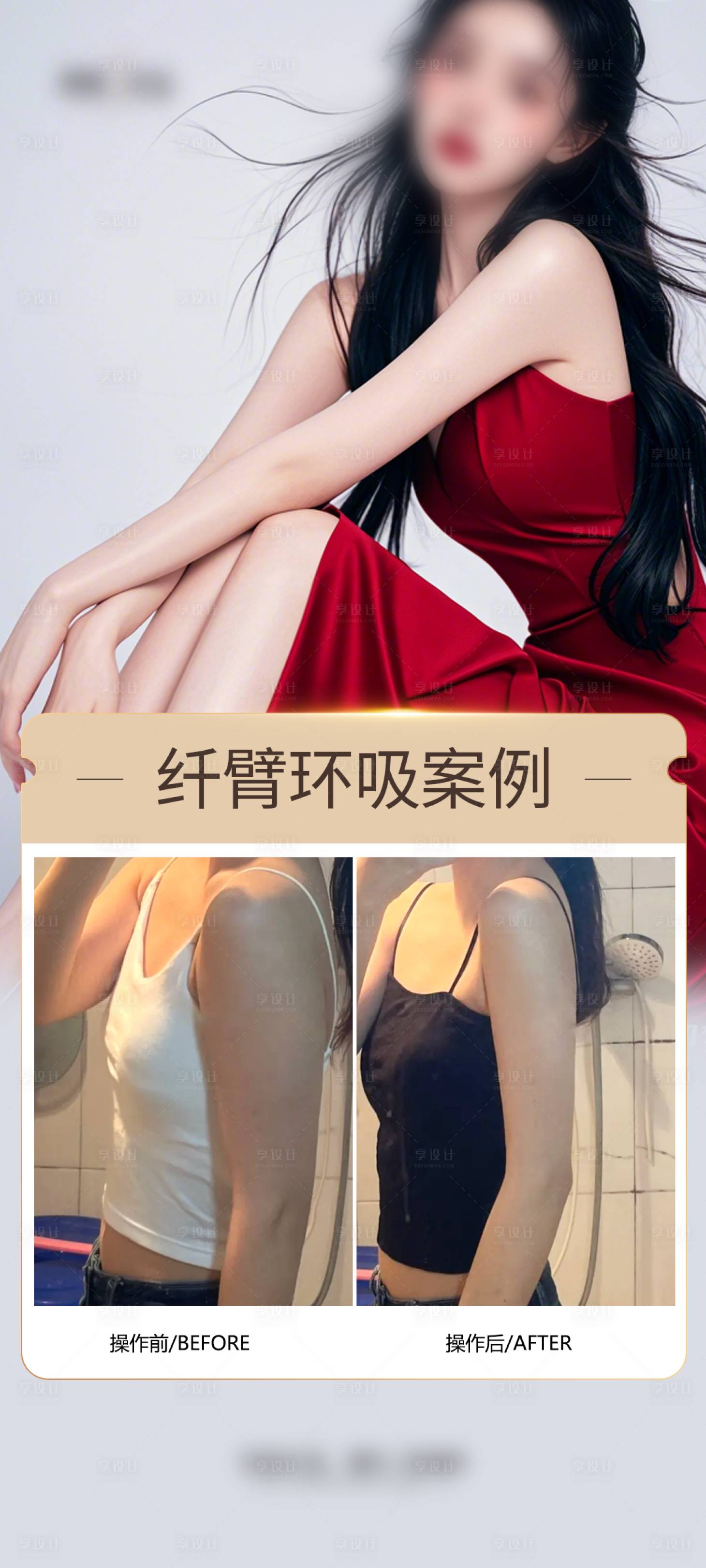 源文件下載【享設(shè)計(jì)】搜索編號(hào)：61870029380894211【醫(yī)美纖細(xì)手臂案例海報(bào)】