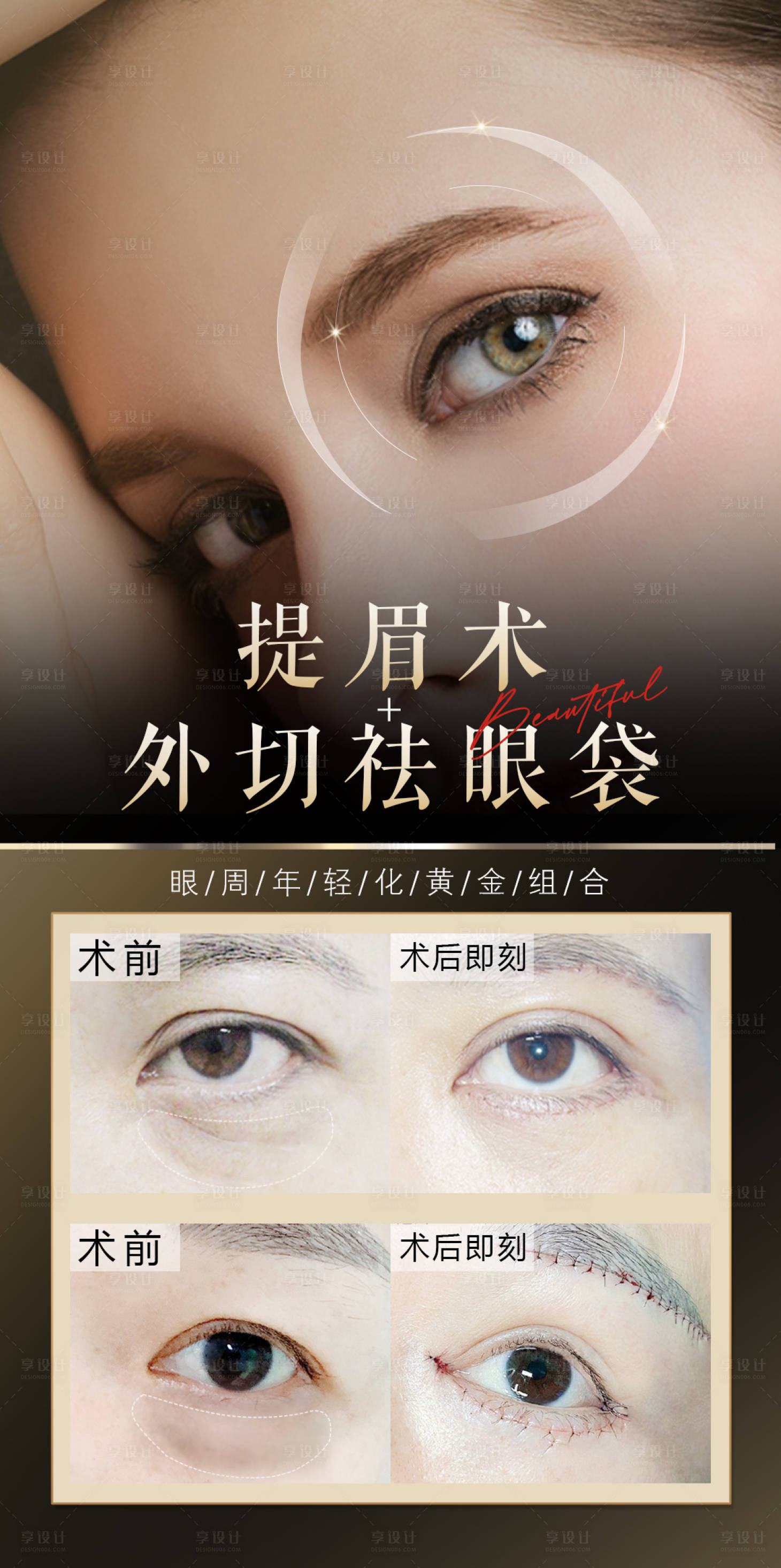 源文件下載【享設計】搜索編號：36220029818294670【提眉祛眼袋醫美案例】