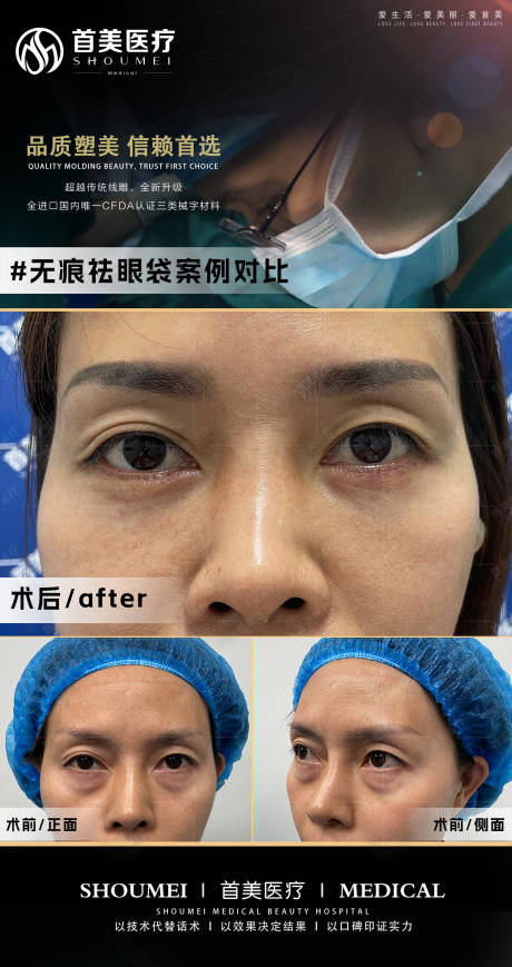 源文件下載【眼袋案例】編號：90980029102324677