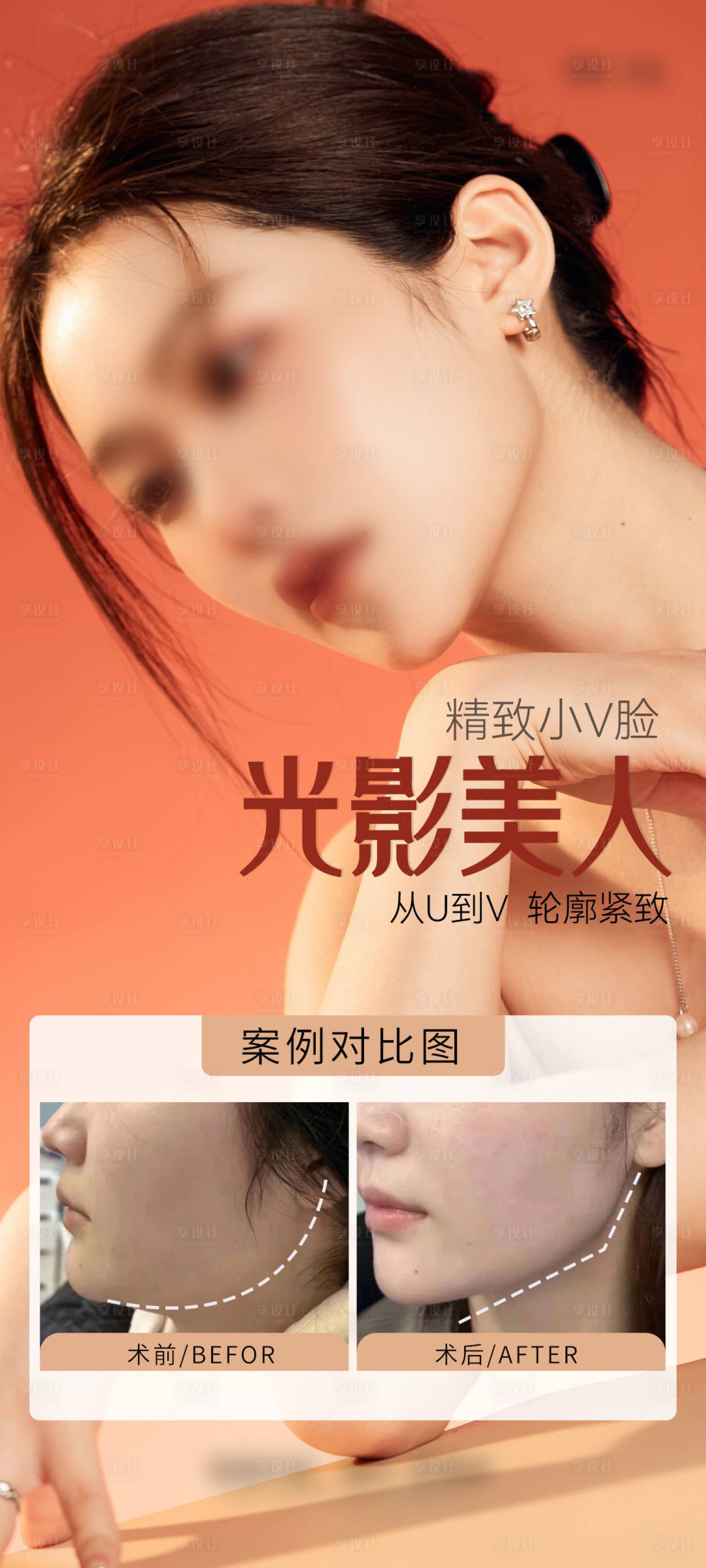 源文件下载【医美V脸案例海报】编号：84480029482552765