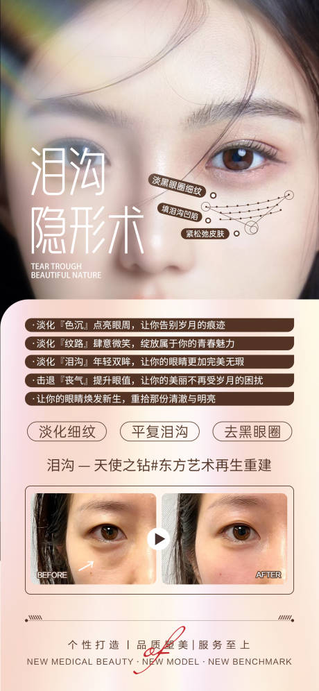 源文件下载【医美泪沟填充案例对比】编号：93790029612178623