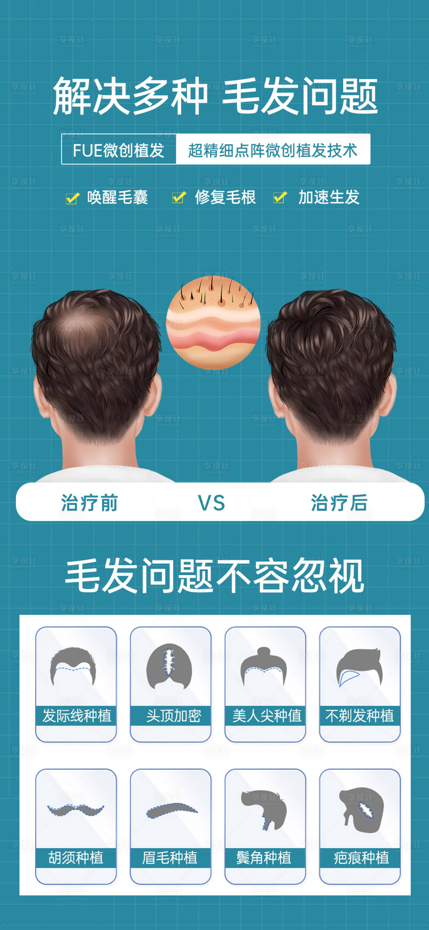 源文件下载【FUE植发海报】编号：76200029795346630