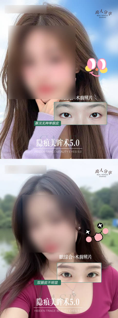 源文件下载【双眼皮 】编号：97340029187376376