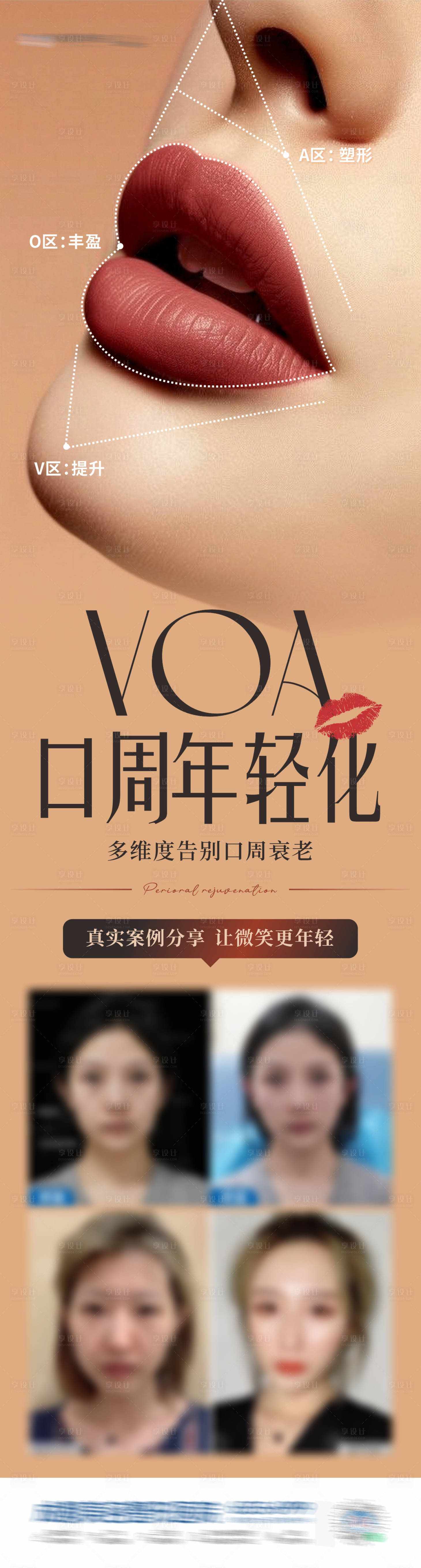 源文件下载【医美口周年轻化案例海报】编号：99130029353907191
