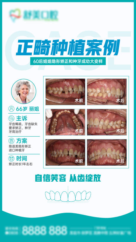 源文件下载【口腔正畸种植案例分享】编号：79710029759488341