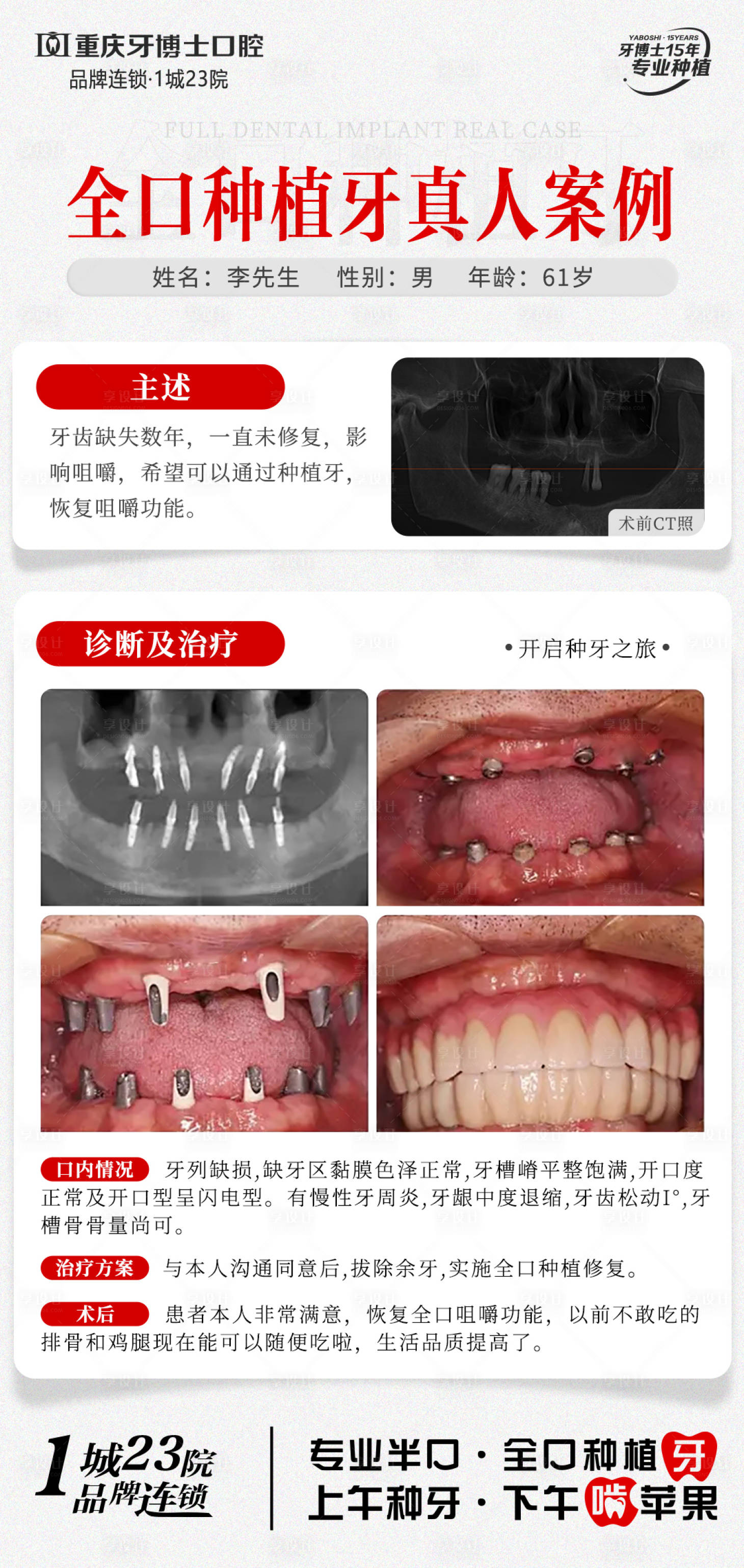源文件下載【享設計】搜索編號：91930029853341044【口腔種植牙案例】