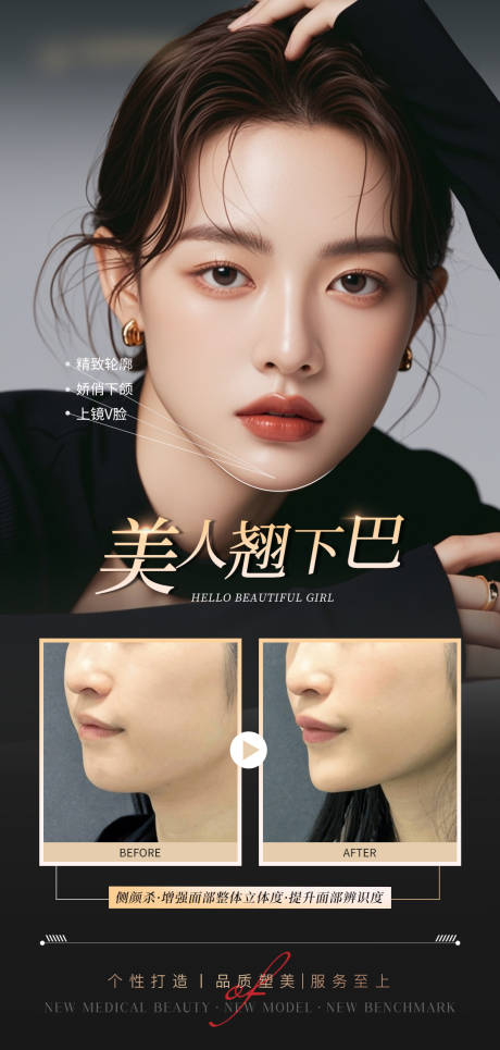 医美下巴填充案例海报