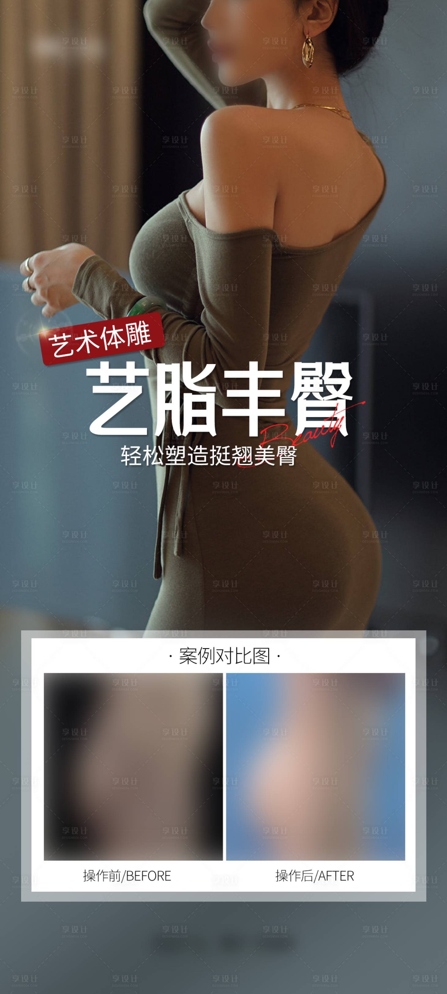 源文件下載【享設(shè)計(jì)】搜索編號(hào)：87670029442937643【醫(yī)美豐臀案例海報(bào)】
