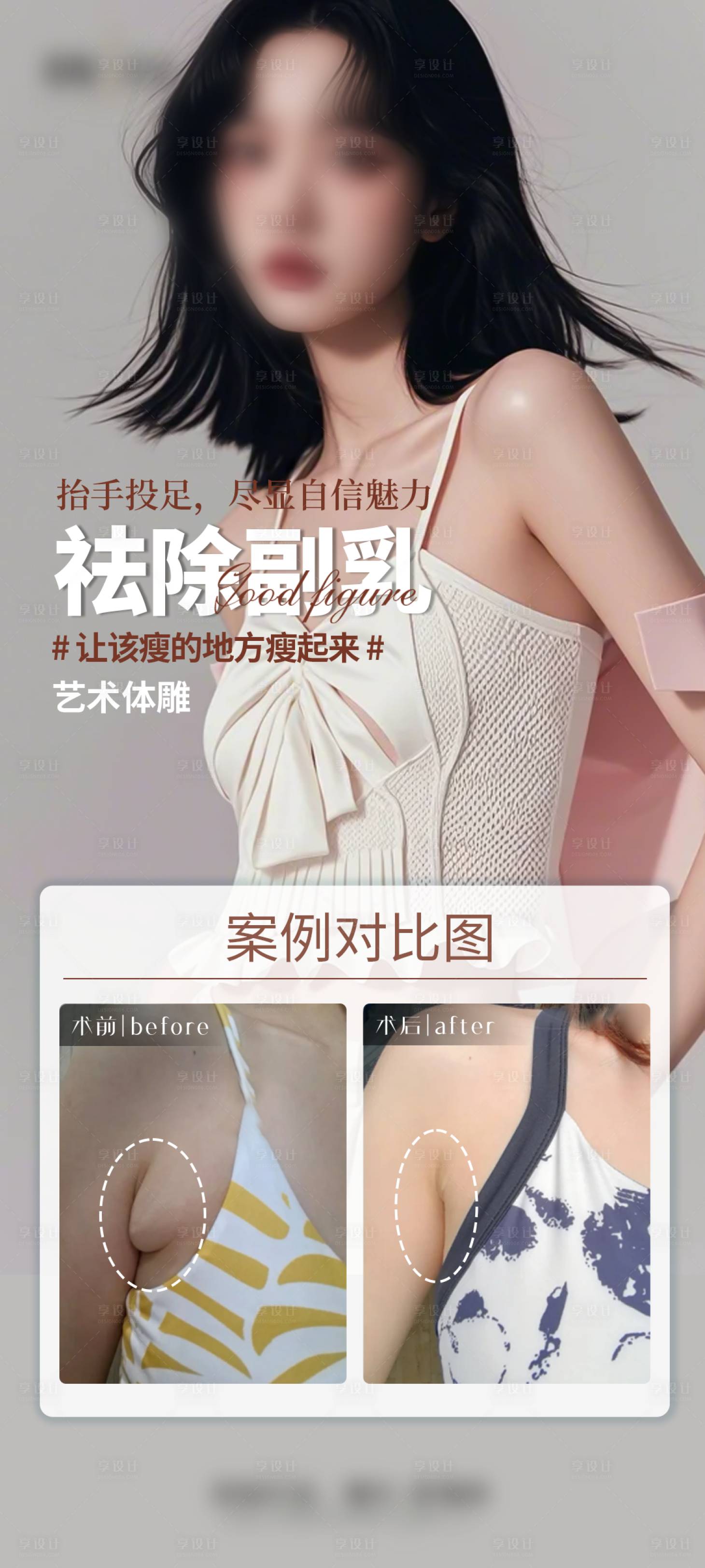 源文件下载【医美祛除副乳案例海报】编号：52330029381071089