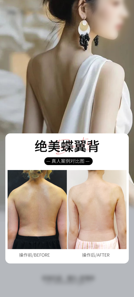源文件下载【医美背案例海报】编号：57860029300268699