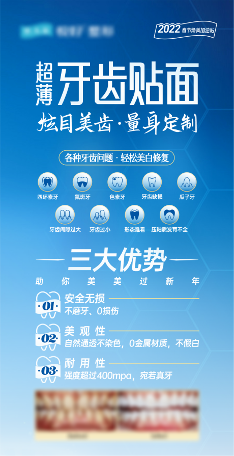 牙齿贴面